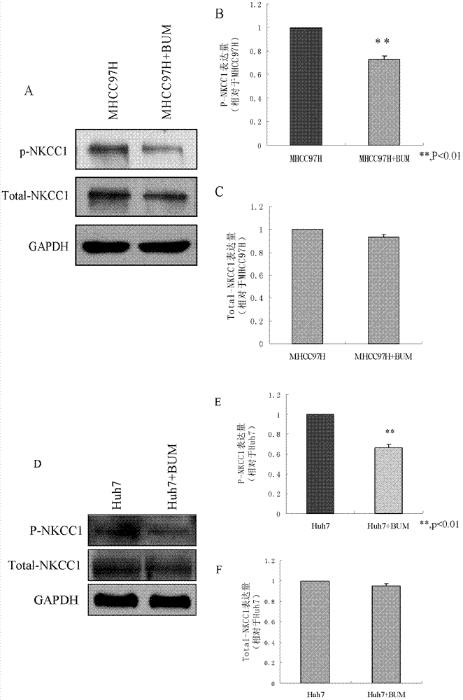Application of bumetanide in inhibition of hepatoma cell transfer