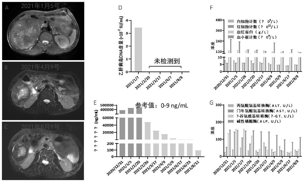 Combined medicine composition for treating megaloblastic liver cancer and application thereof in preparation of medicine for treating megaloblastic liver cancer