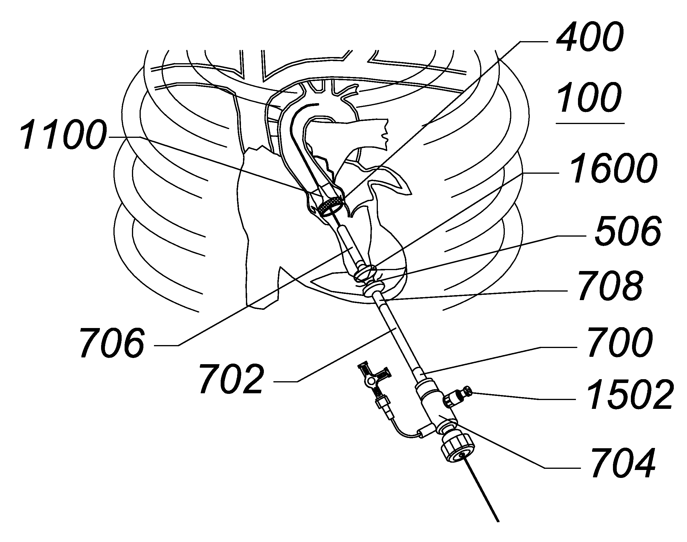 Expandable transapical sheath and method of use