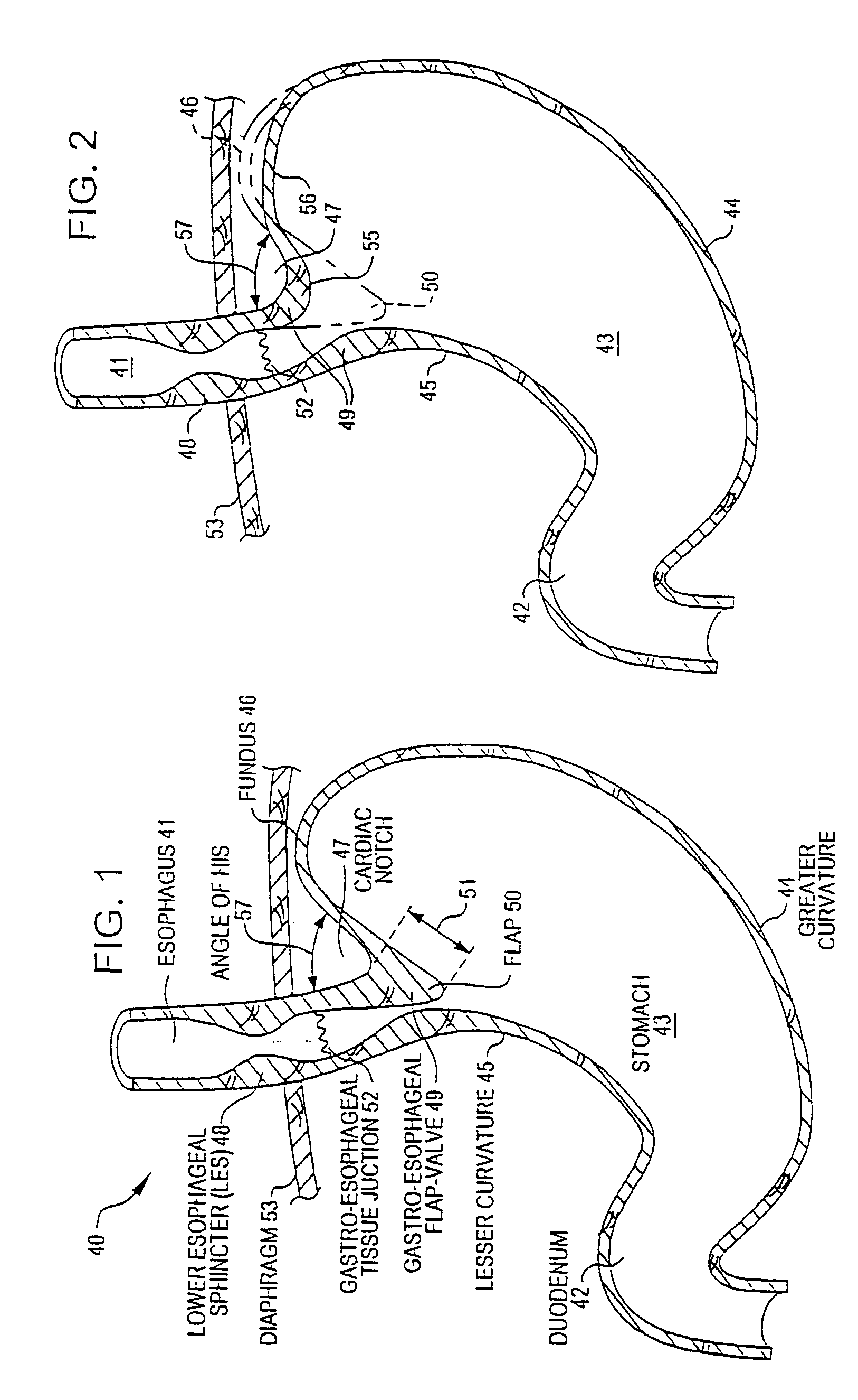 Tissue fixation devices and assemblies for deploying the same