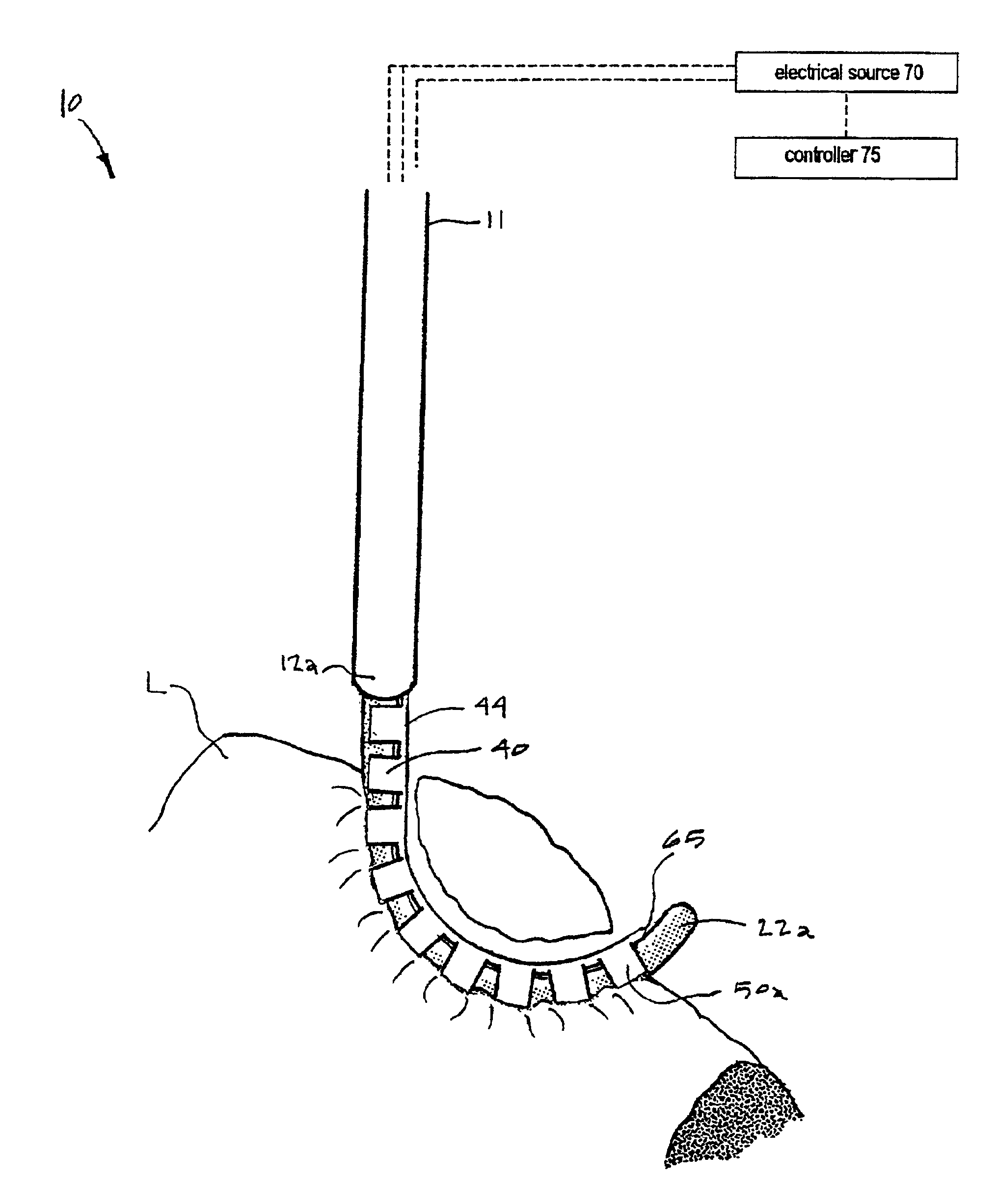 Electrosurgical working end and method for obtaining tissue samples for biopsy