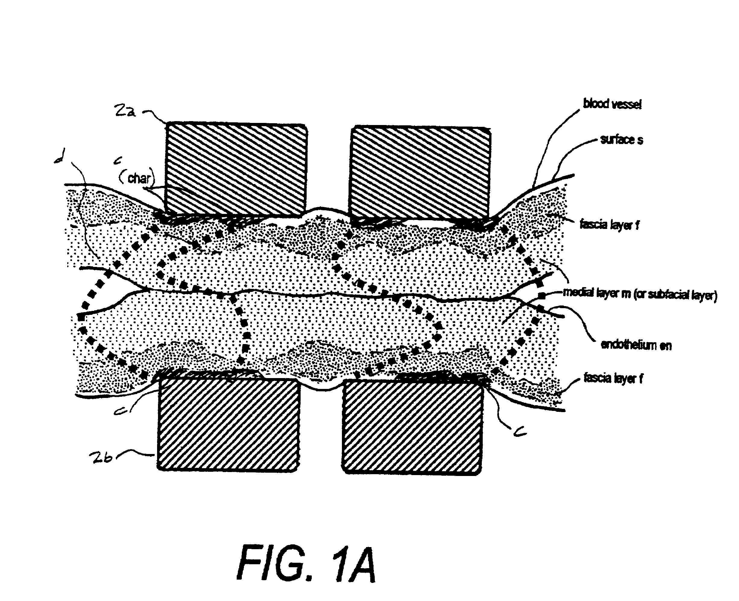 Electrosurgical working end and method for obtaining tissue samples for biopsy