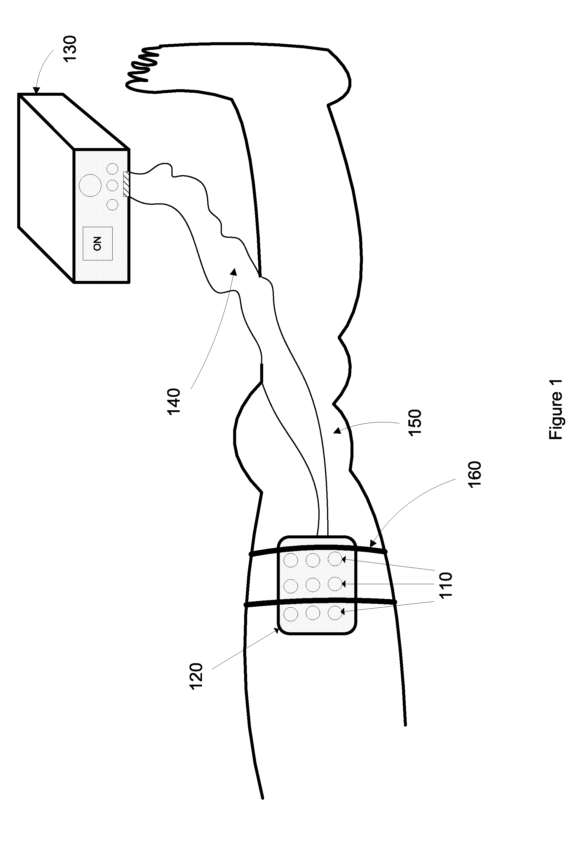Device, system, and method to improve powered muscle stimulation performance in the presence of tissue edema