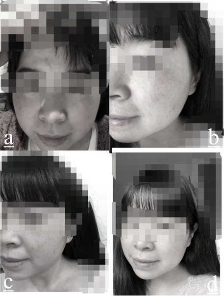 Innovative whitening, brightening and freckle-removing cream and preparation method thereof
