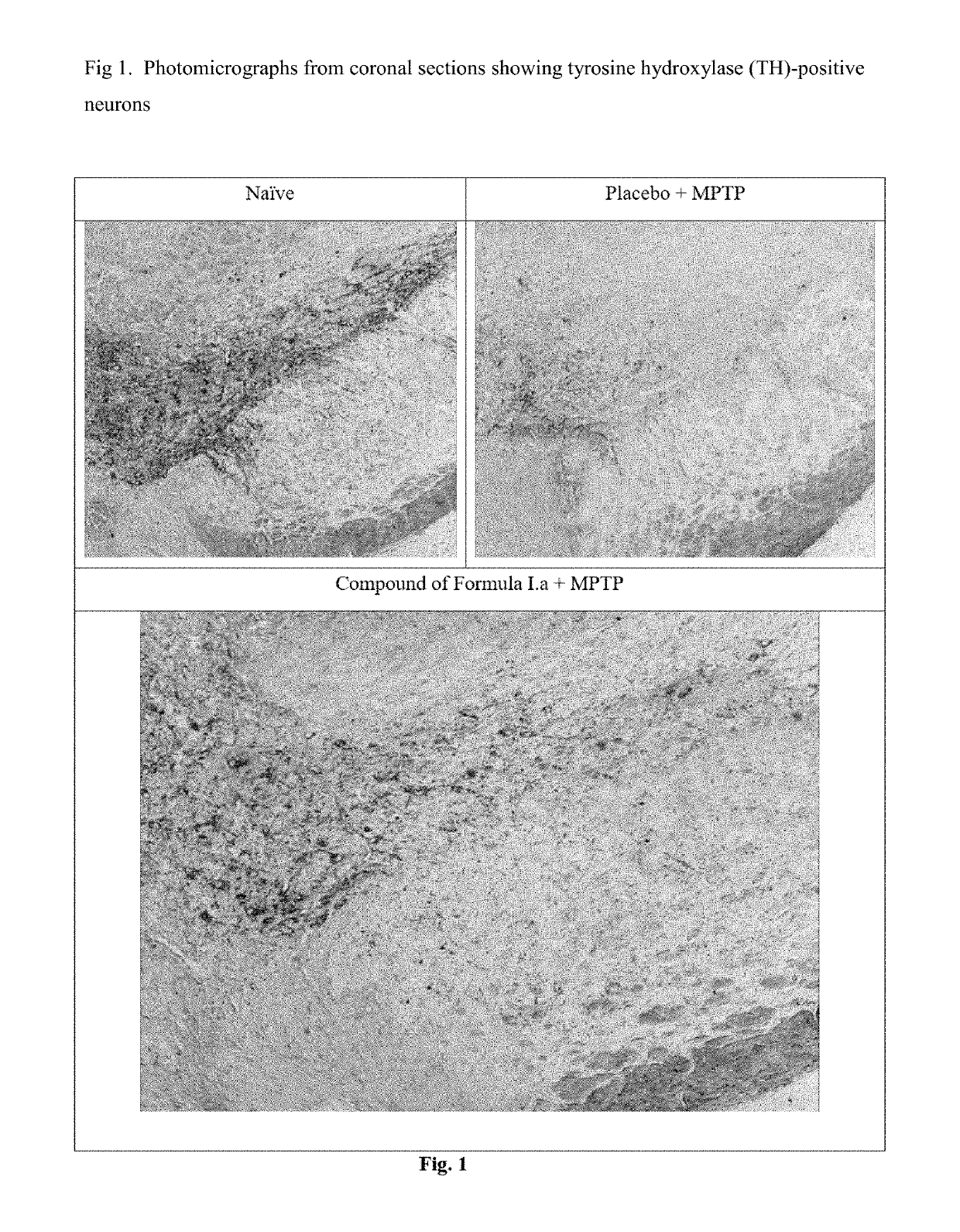 Treatment of parkinson's disease