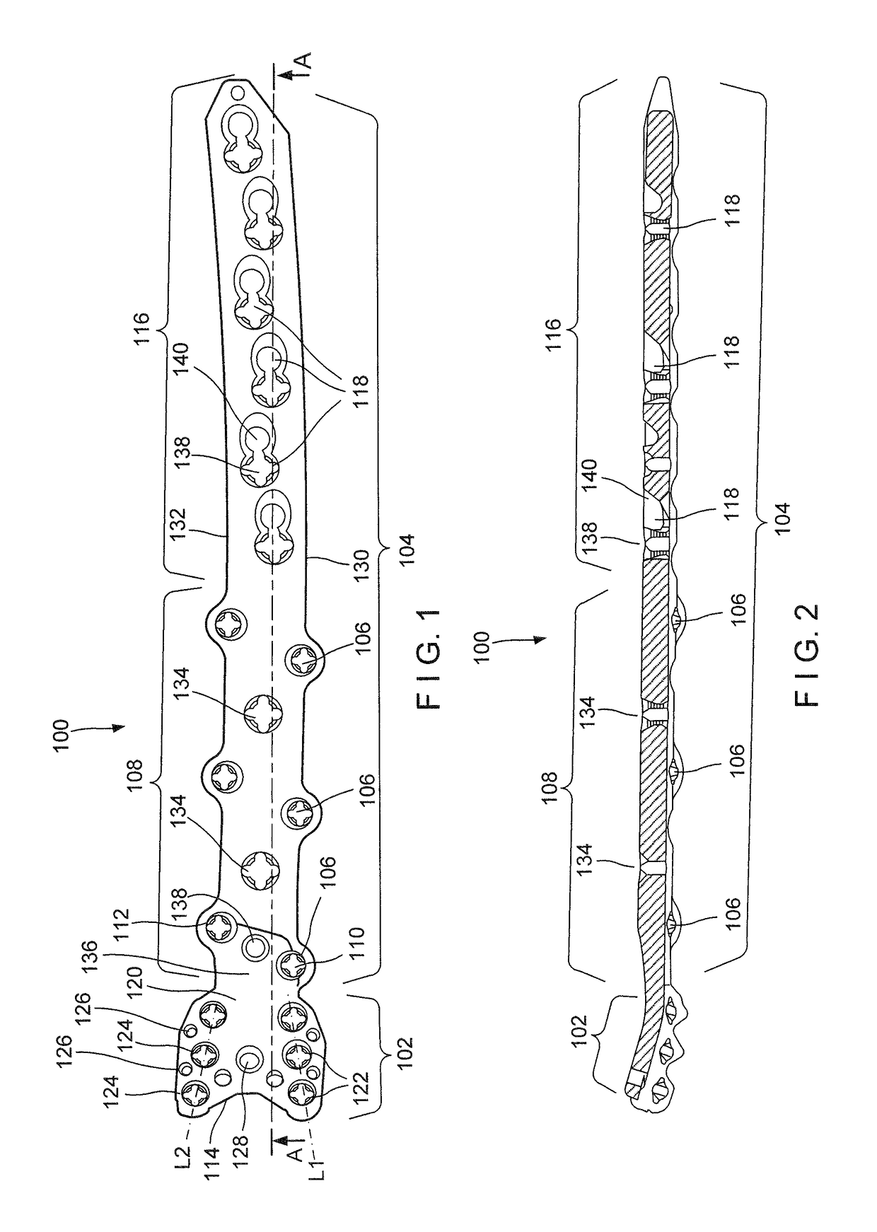 Proximal Femur Plate System