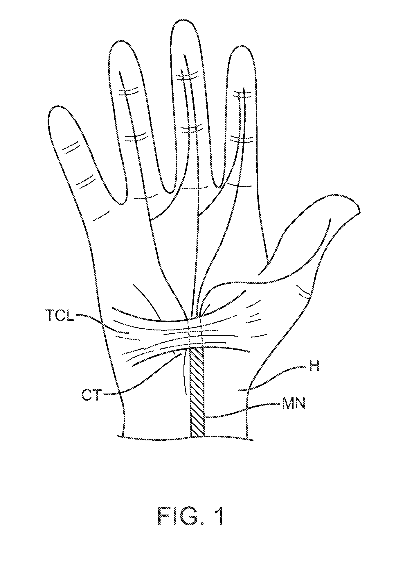 Methods and devices to treat compressive neuropathy and other diseases