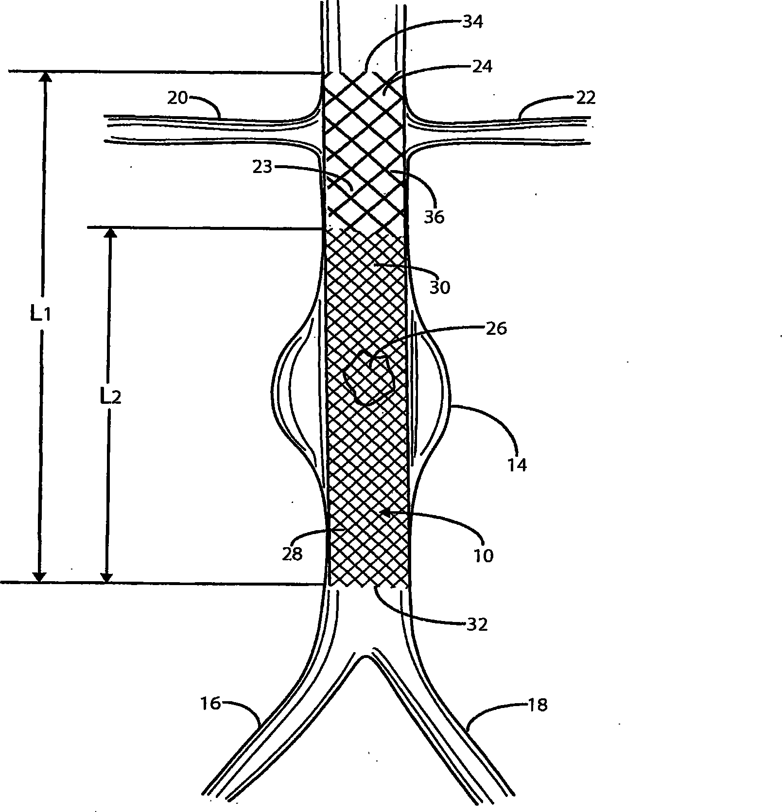 Intravascular deliverable stent for reinforcement of vascular abnormalities