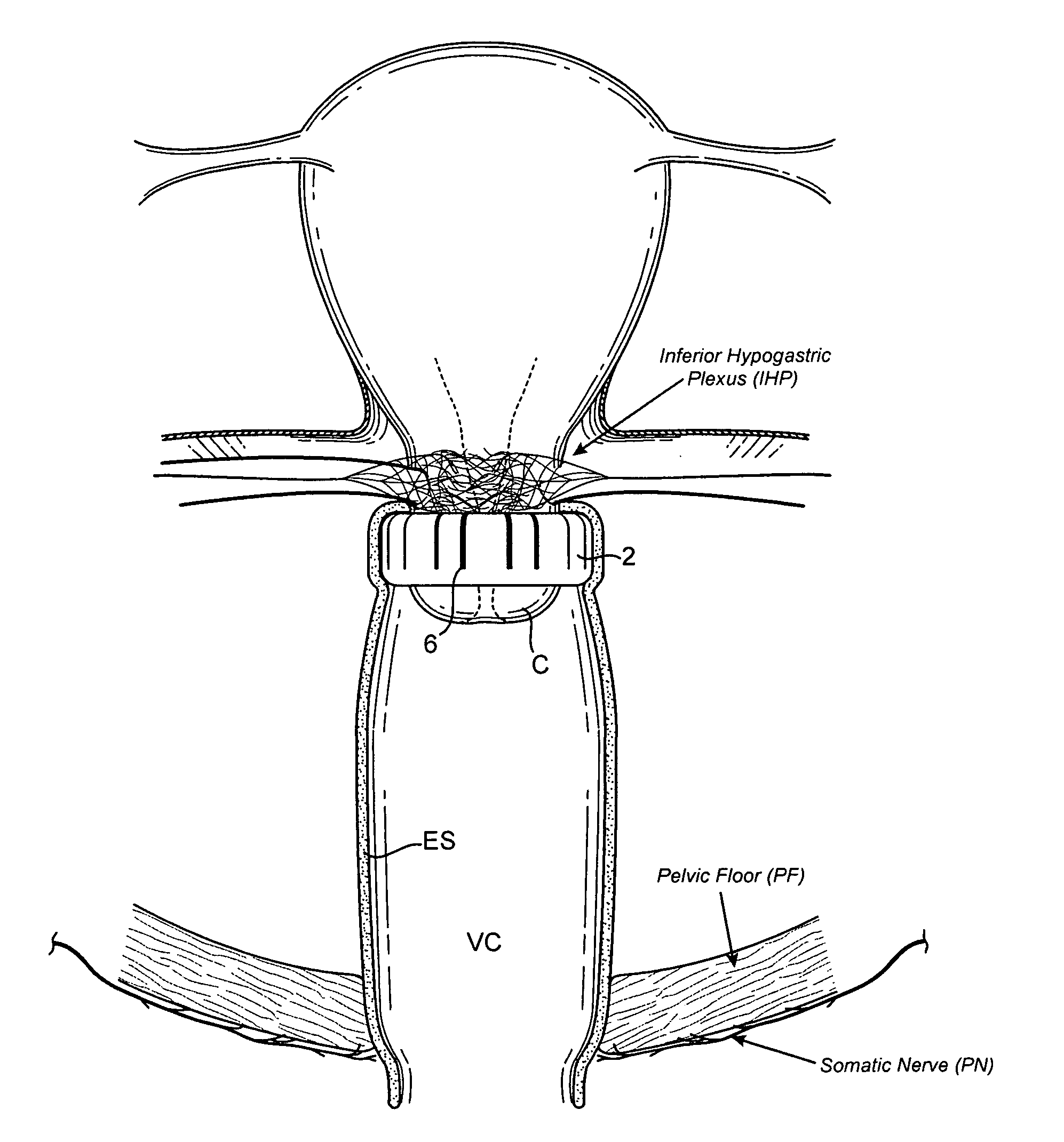 Devices and methods for stimulating nerves