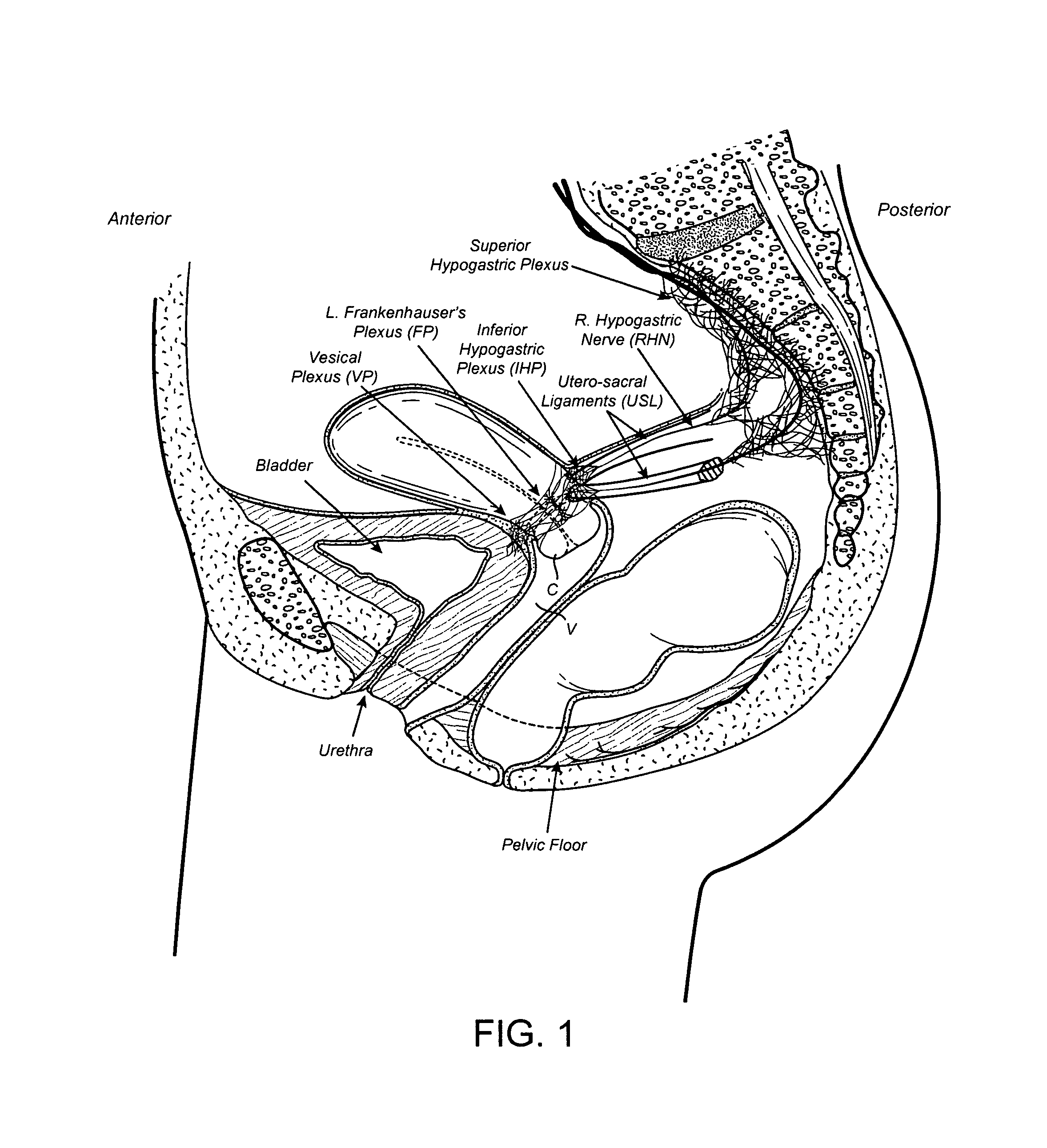 Devices and methods for stimulating nerves