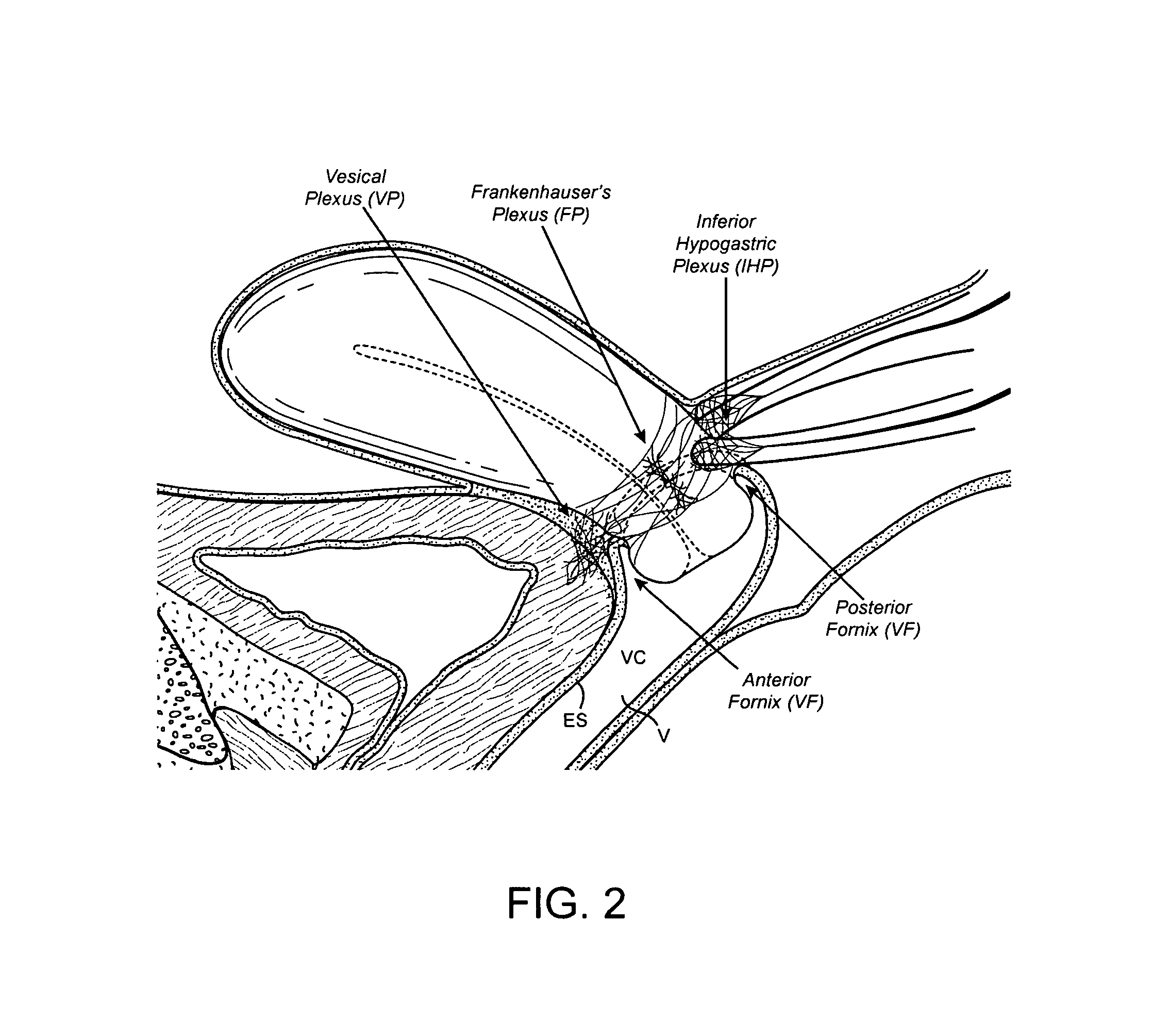 Devices and methods for stimulating nerves