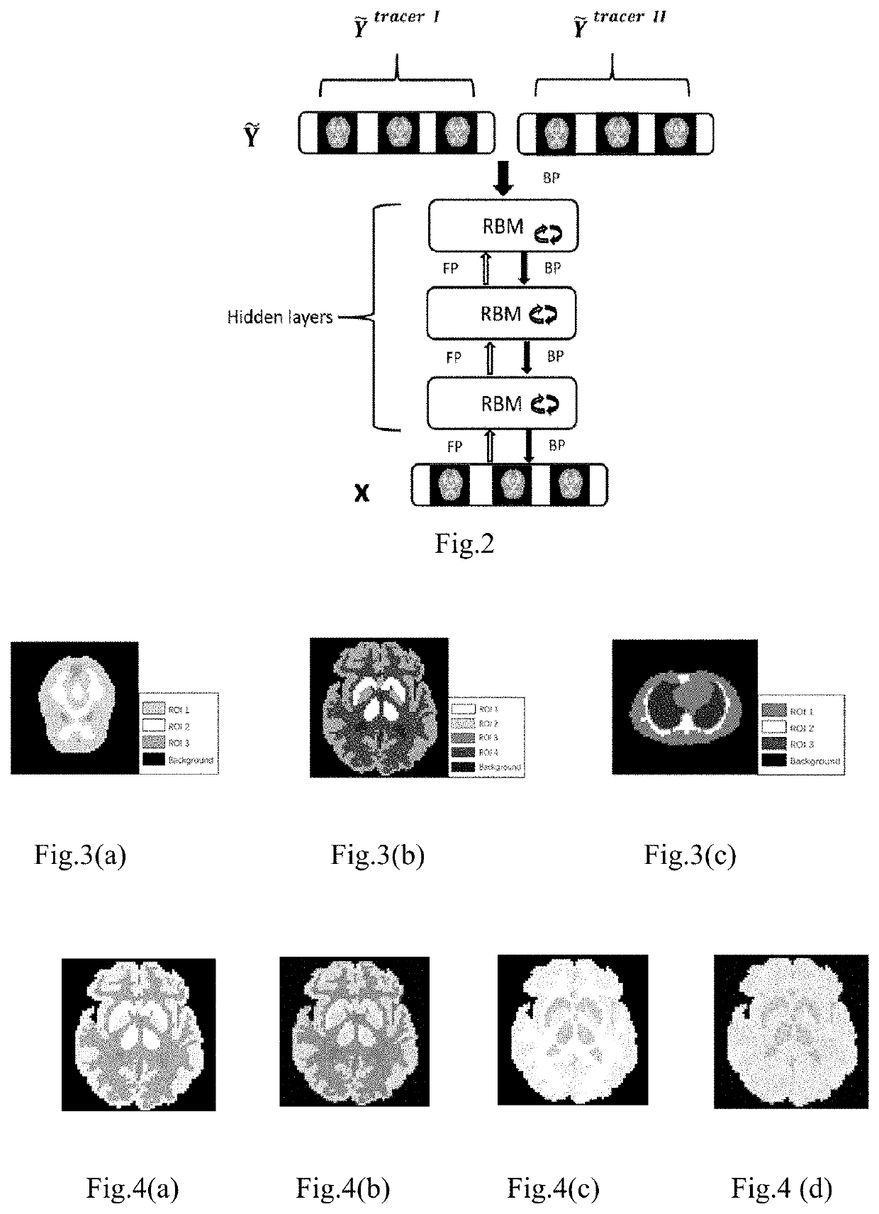 Deep-learning based separation method of a mixture of dual-tracer single-acquisition pet signals with equal half-lives