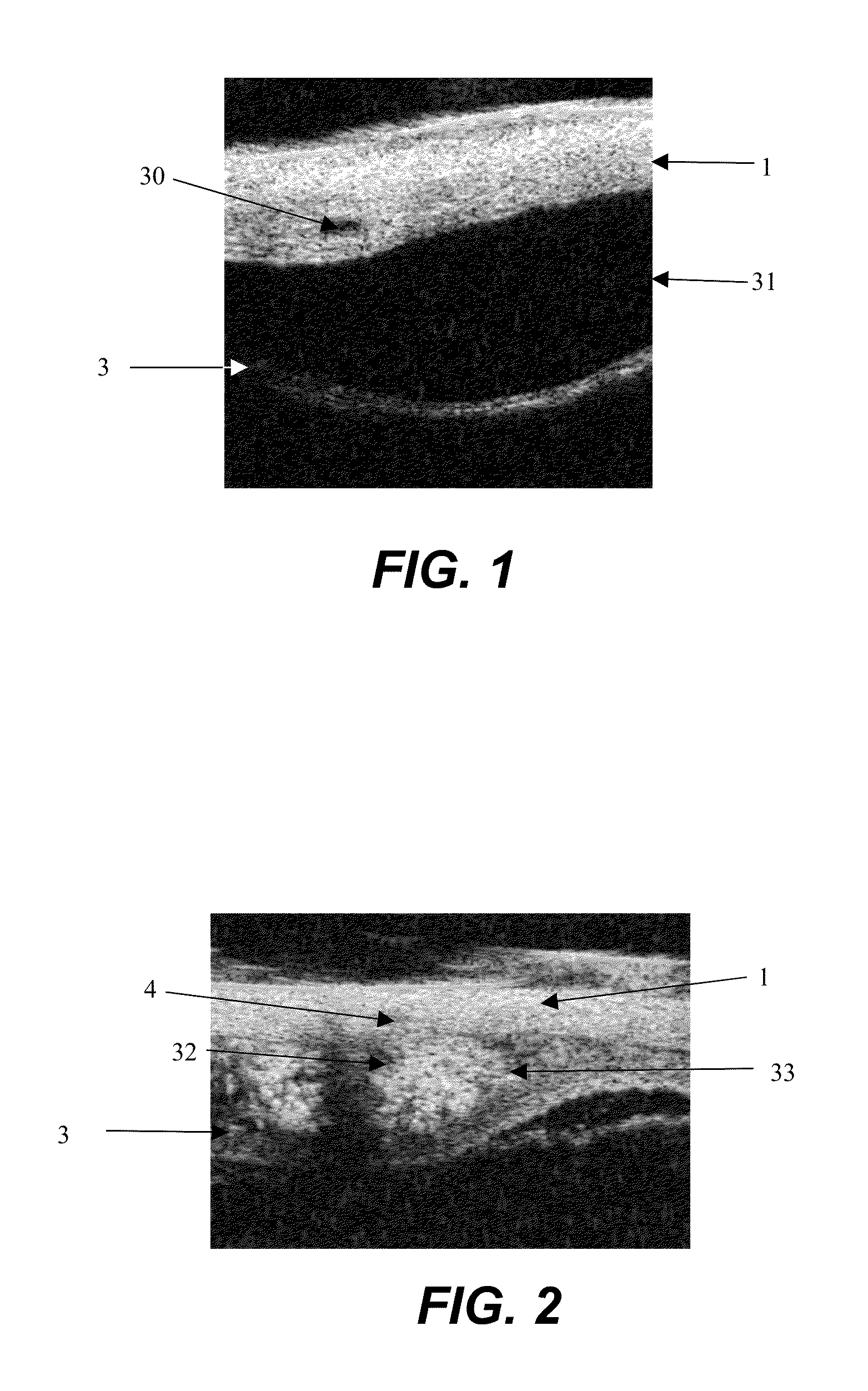 Apparatus and formulations for suprachoridal drug delivery