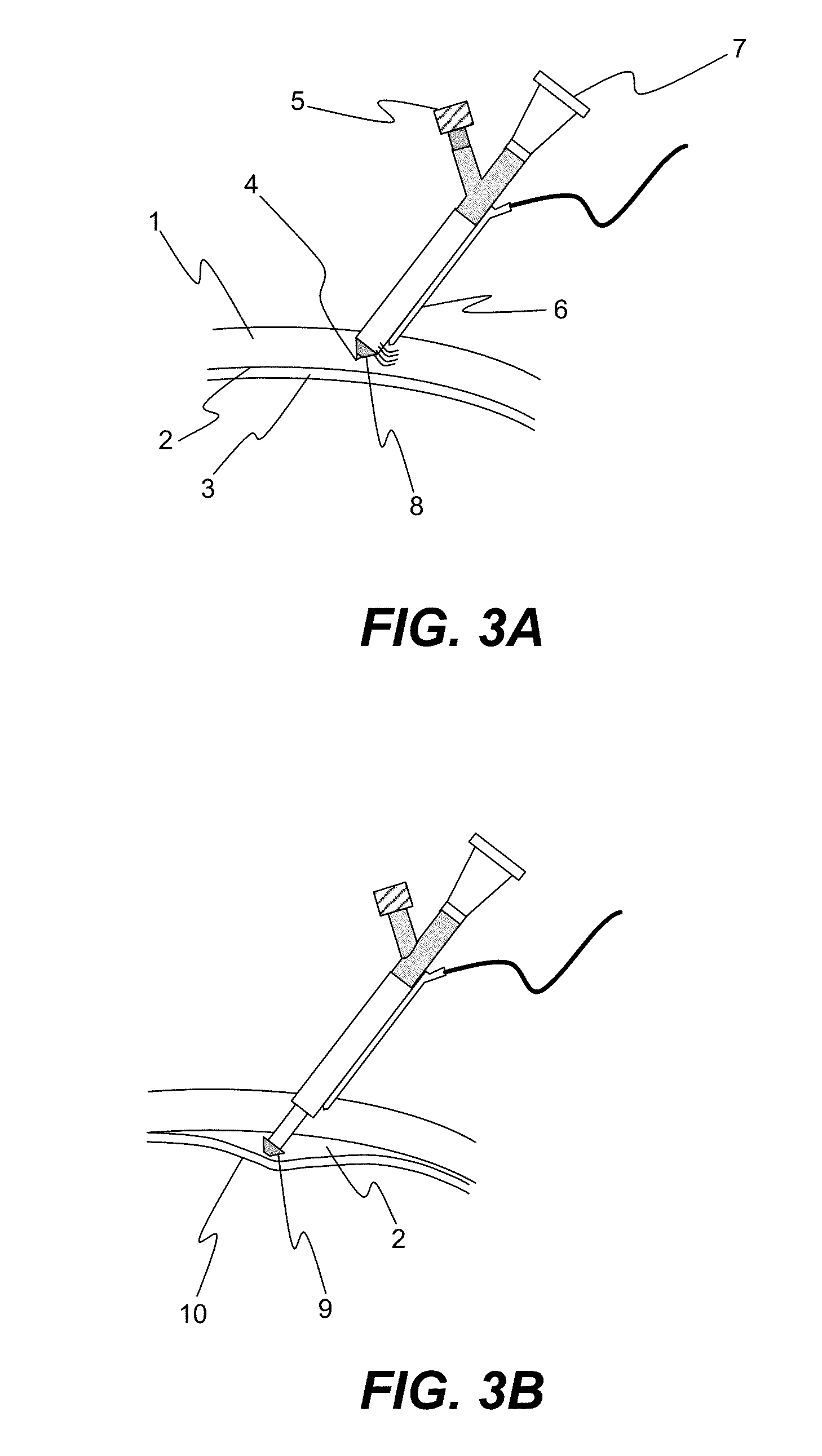 Apparatus and formulations for suprachoridal drug delivery