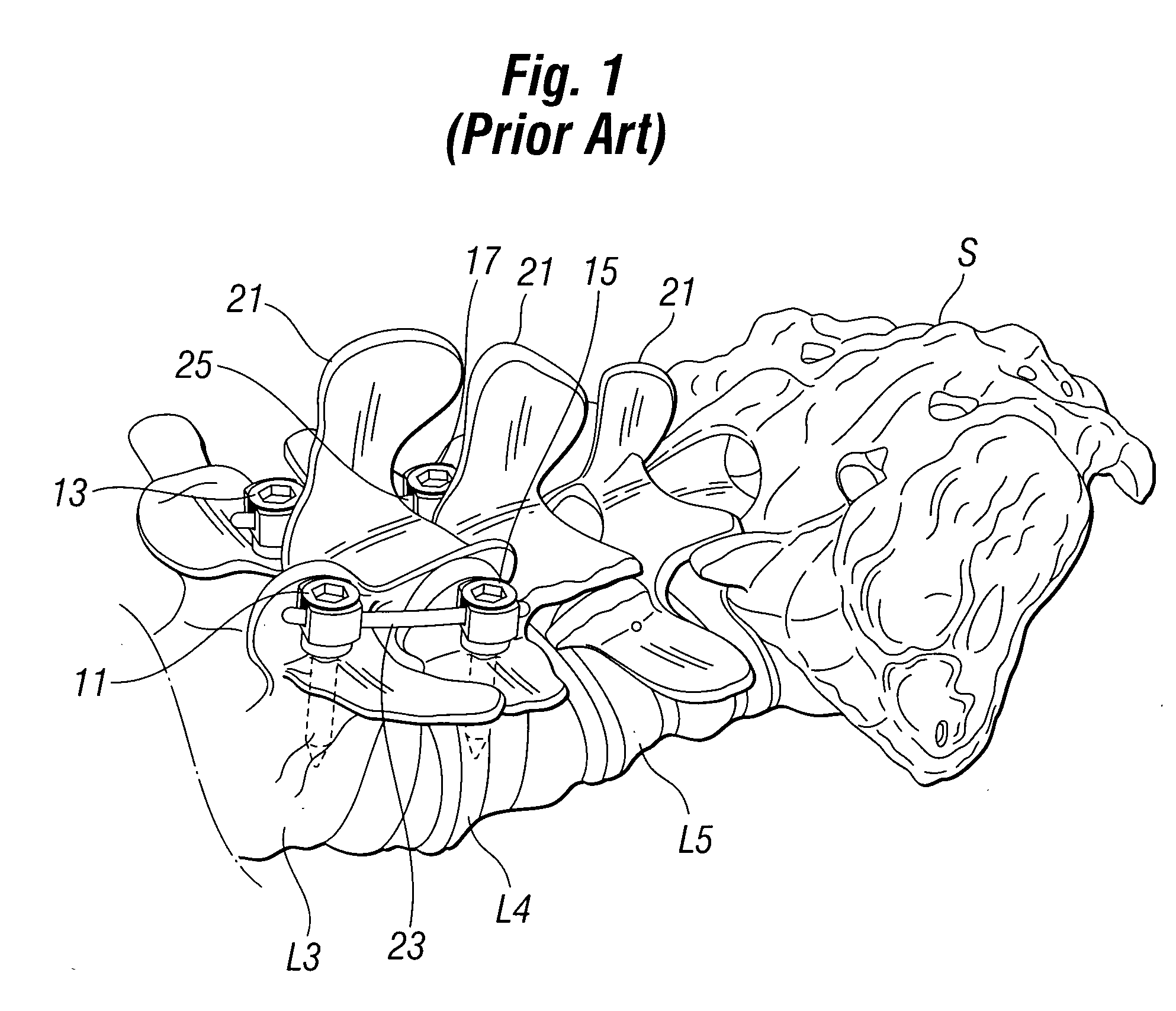 Pedicle dart system