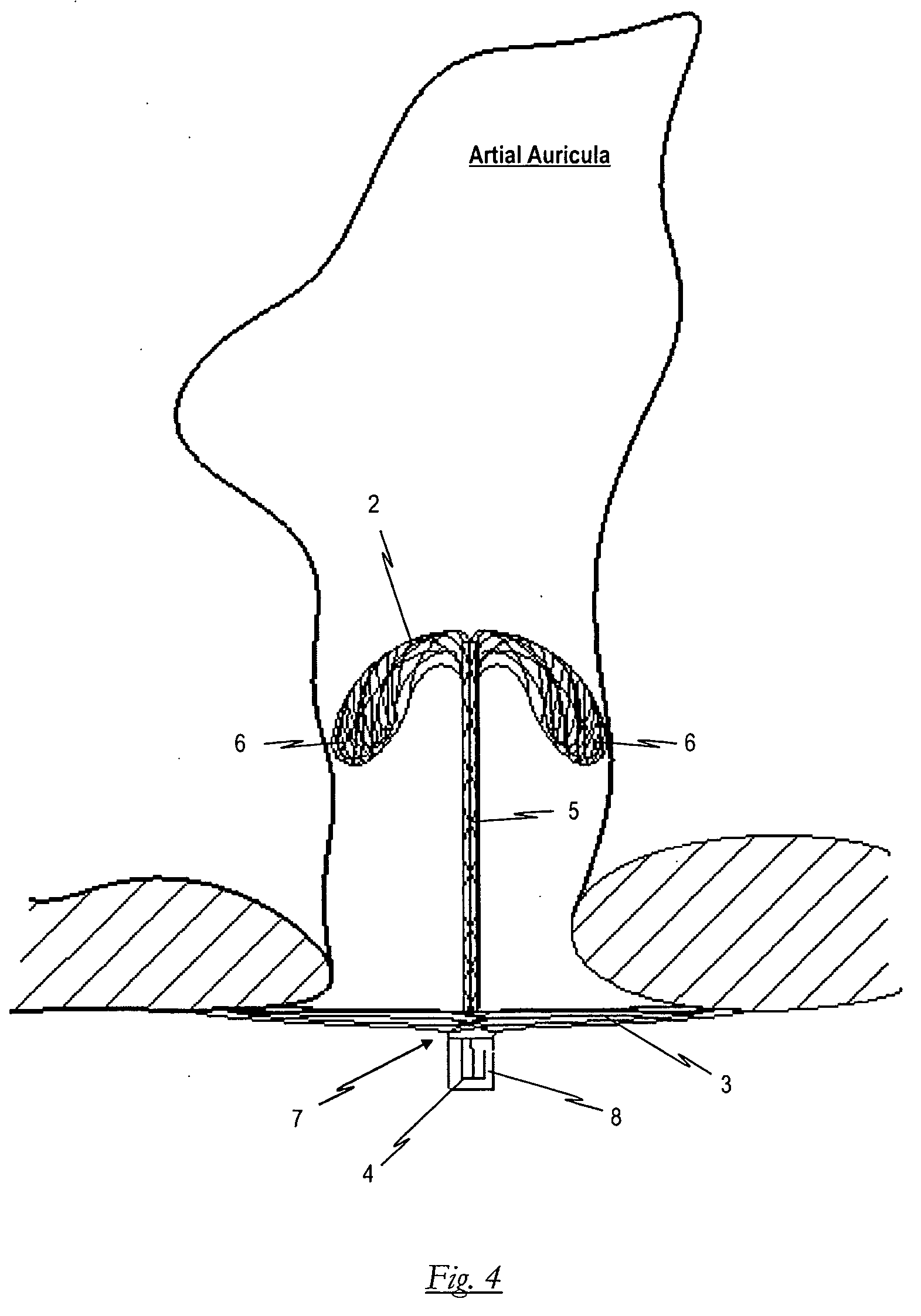 Occlusion device for occluding an atrial auricula and method for producing same