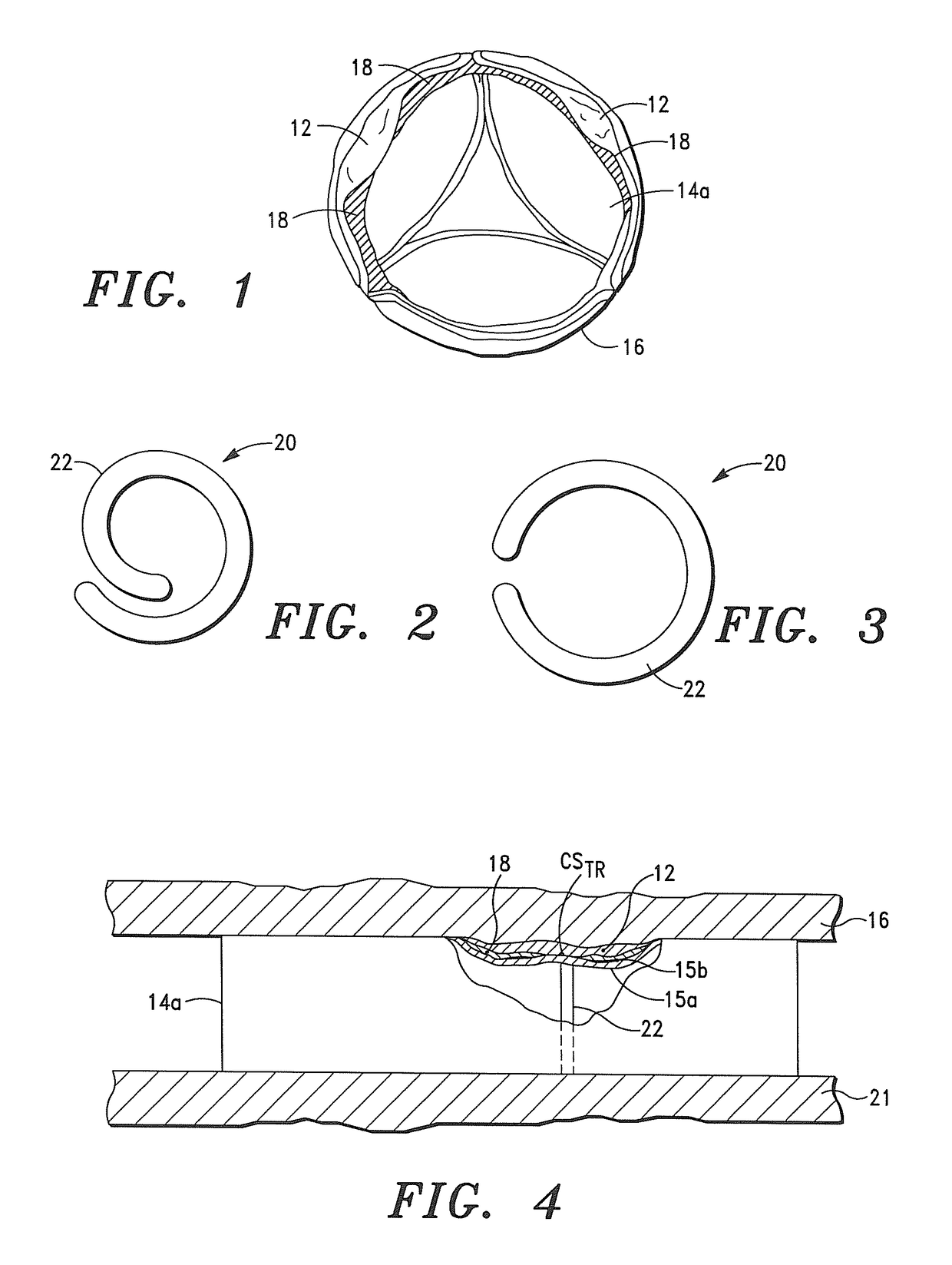 Systems, apparatus and methods for sealing perivalvular leaks