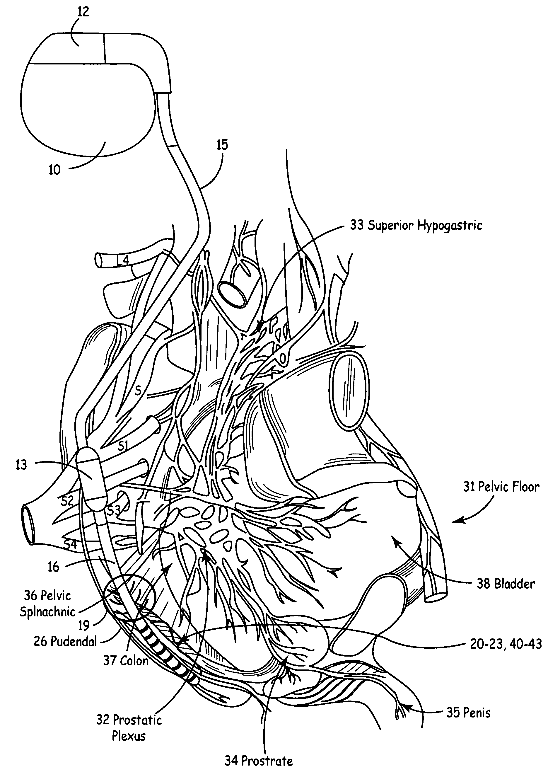 Method, system and device for treating disorders of the pelvic floor by means of electrical stimulation of the pudendal and associated nerves, and the optional delivery of drugs in association therewith