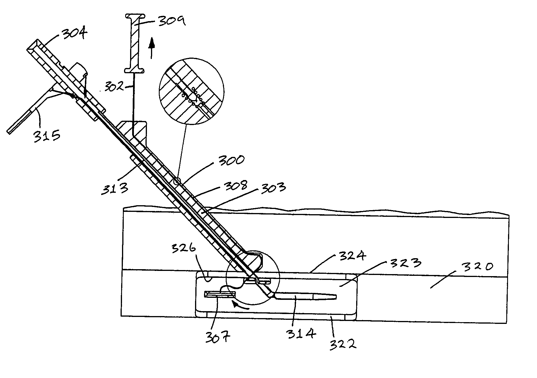 Interventional medical closure device