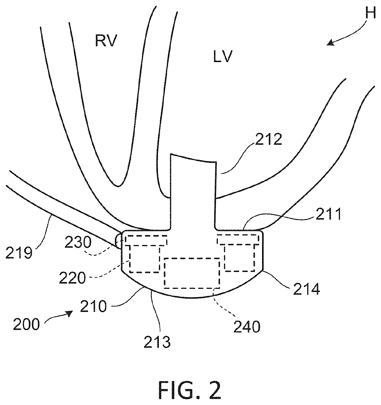 Methods and systems for bone conduction audible alarms for mechanical circulatory support systems