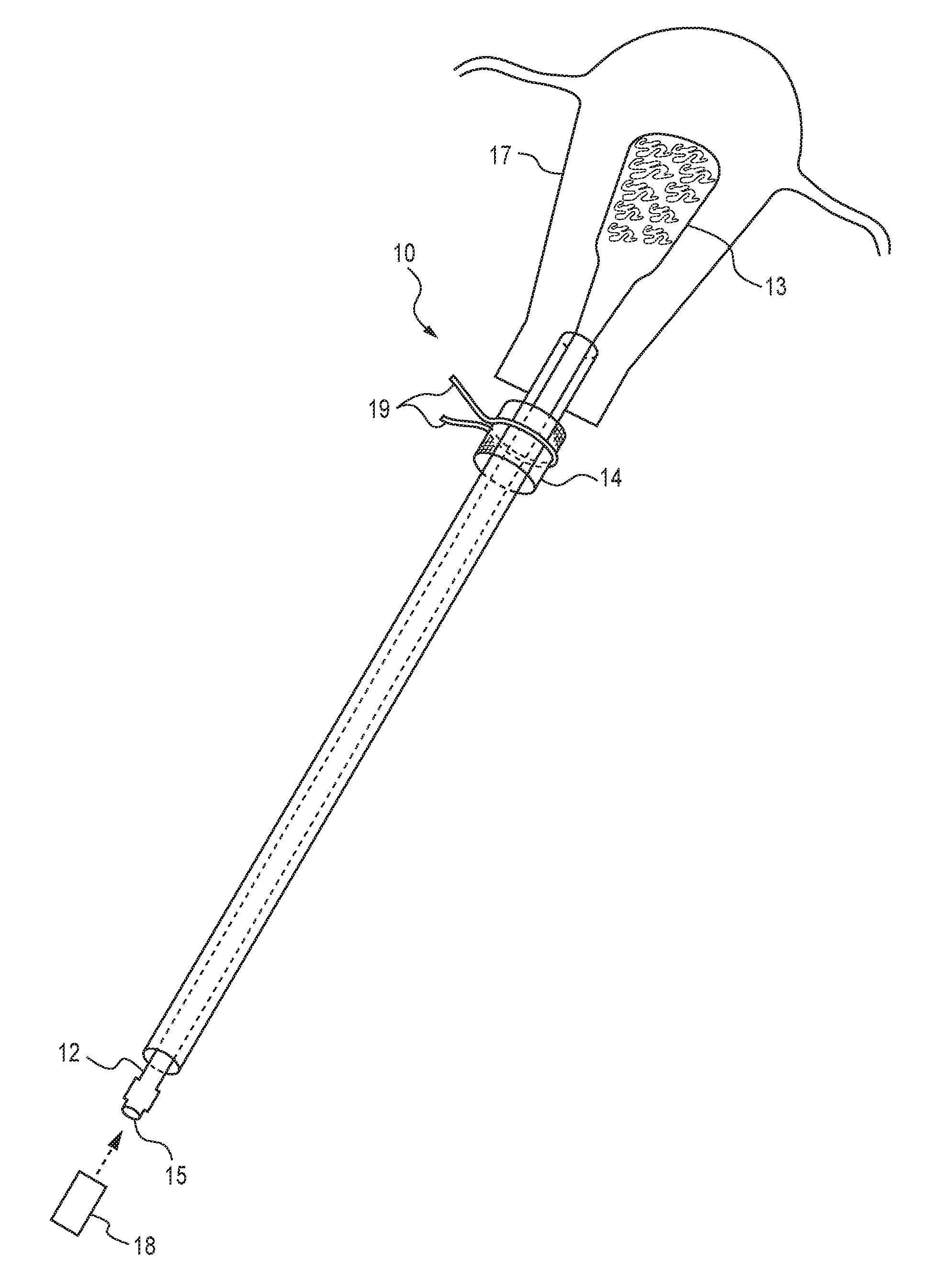 Device for instillation of a chemical agent into the endometrial cavity for purpose of global endometrial ablation