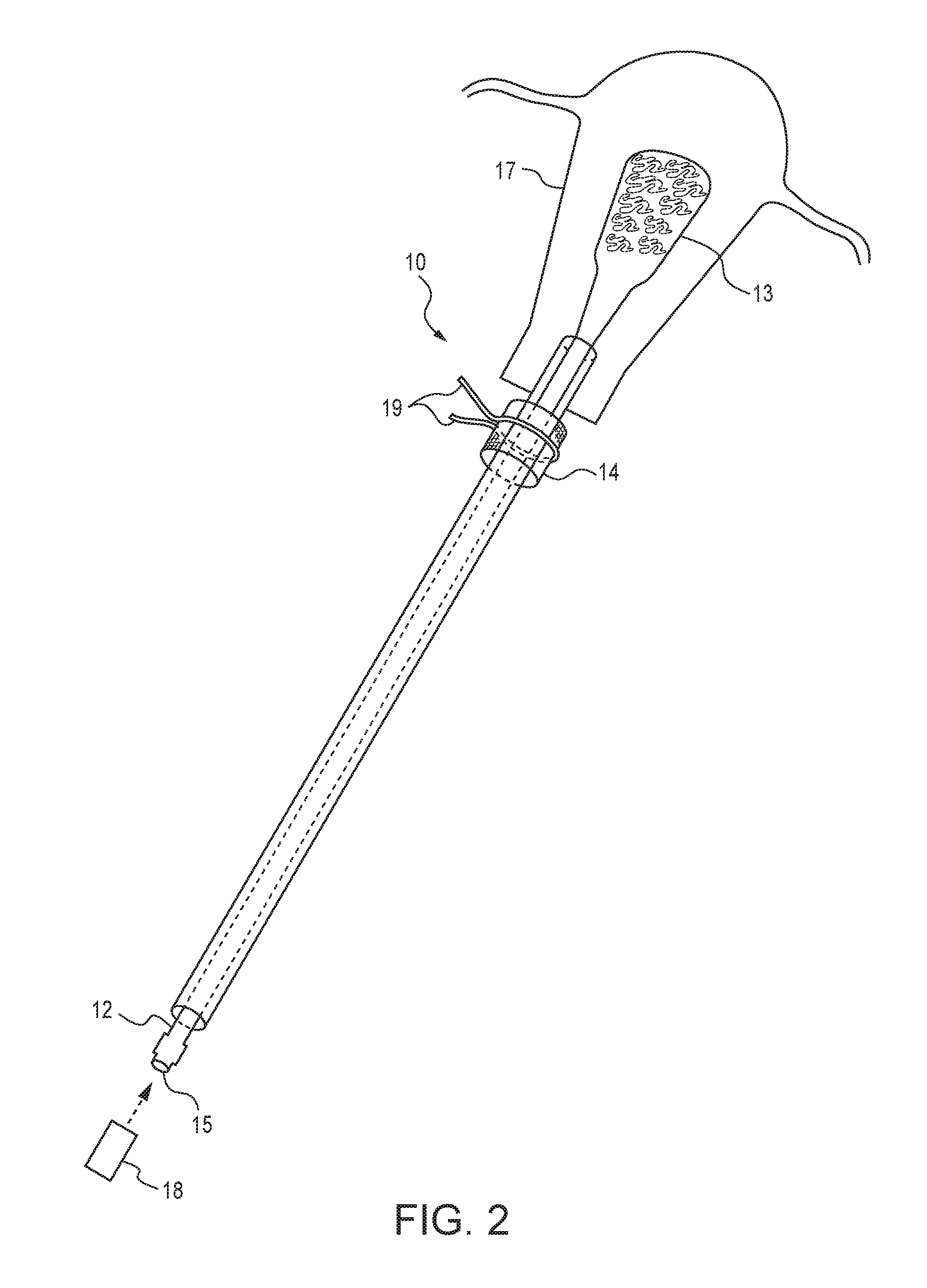 Device for instillation of a chemical agent into the endometrial cavity for purpose of global endometrial ablation