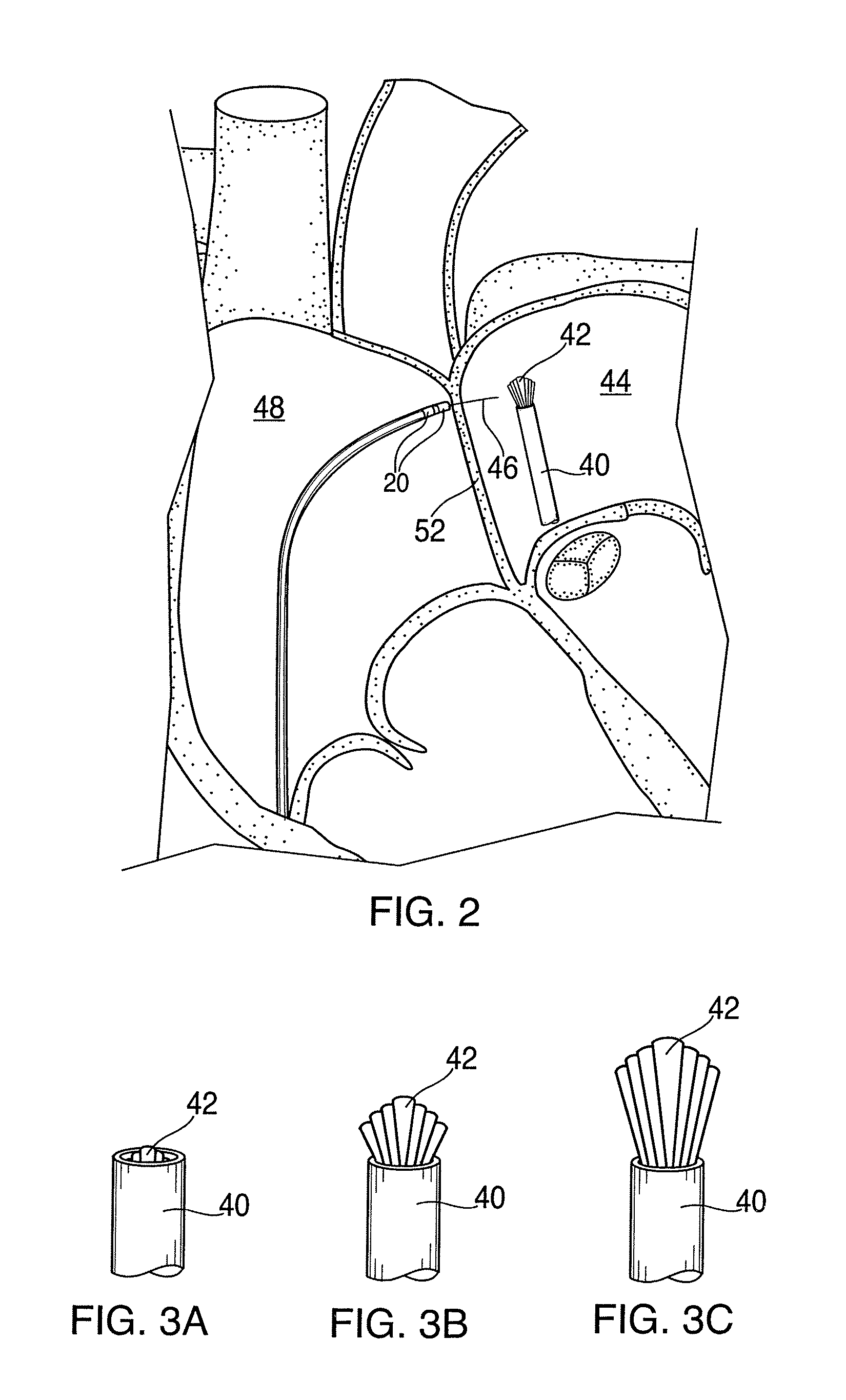 Apparatus for safe performance of transseptal technique and placement and positioning of an ablation catheter