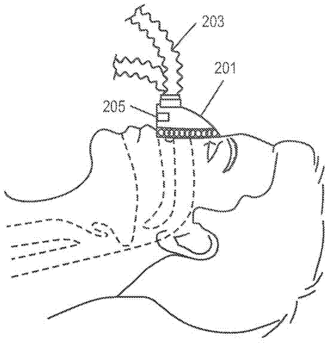 Methods, systems and devices for non-invasive ventilation comprising a non-sealed ventilation interface featuring a free-space nozzle