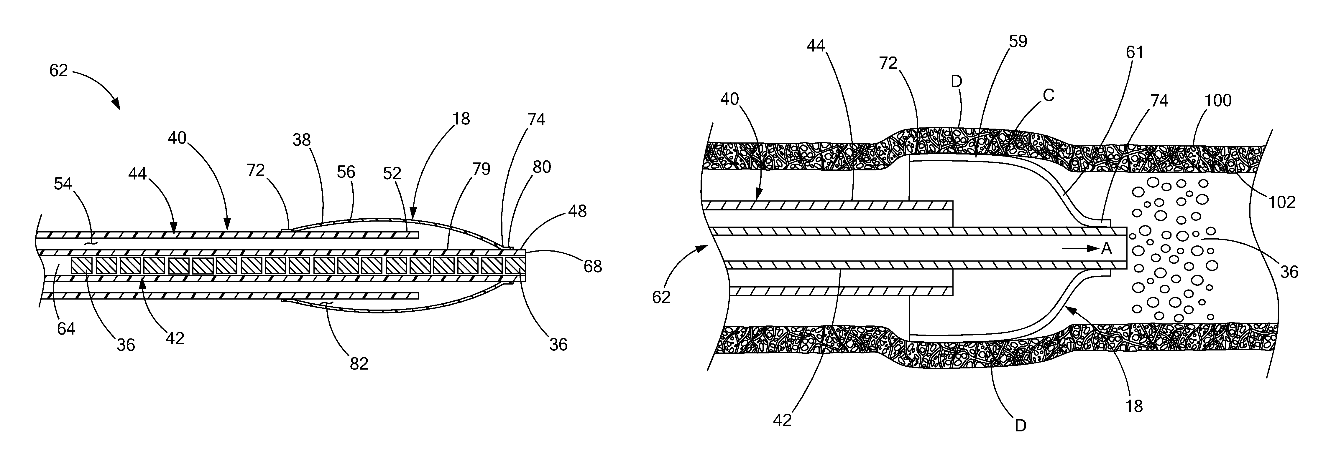 Occlusion device