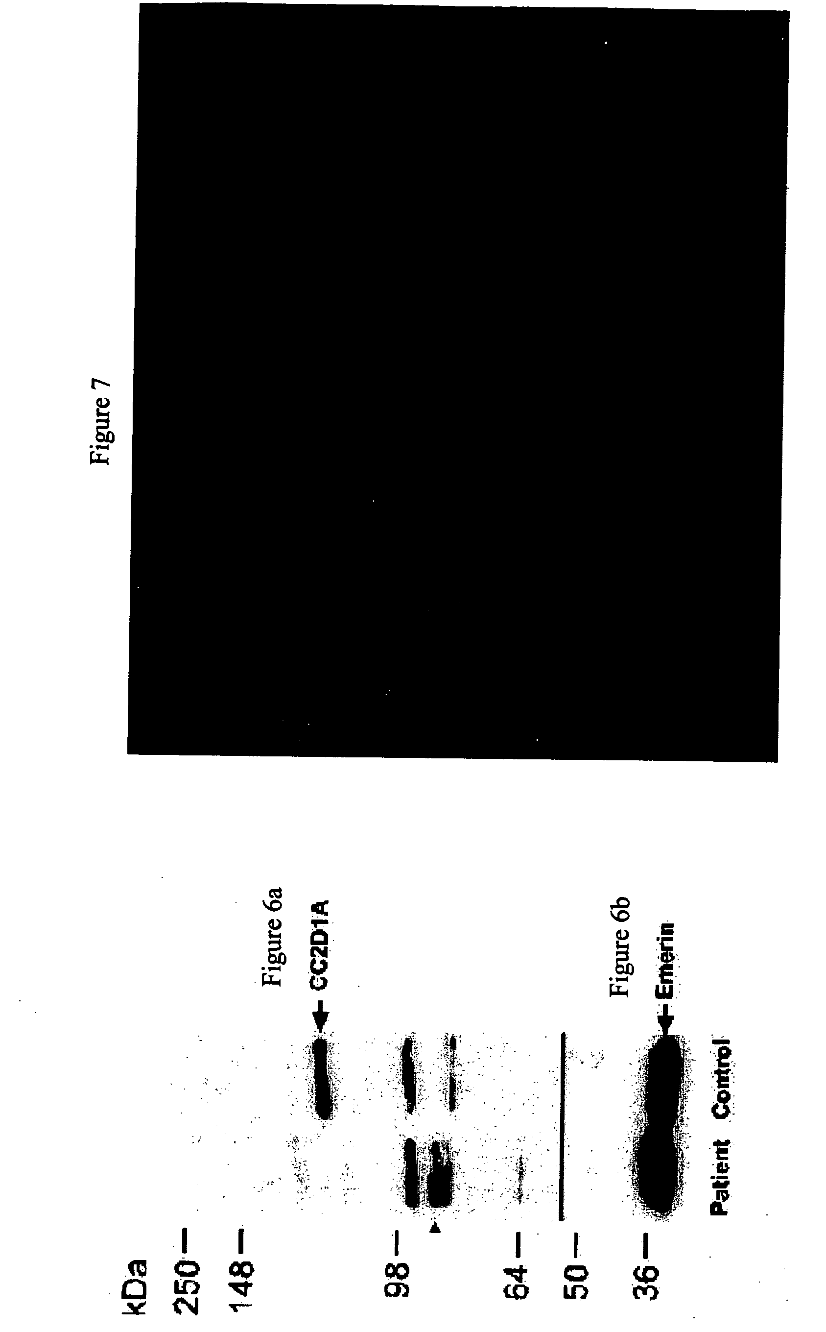 Methods and kits for diagnosing and treating mental retardation