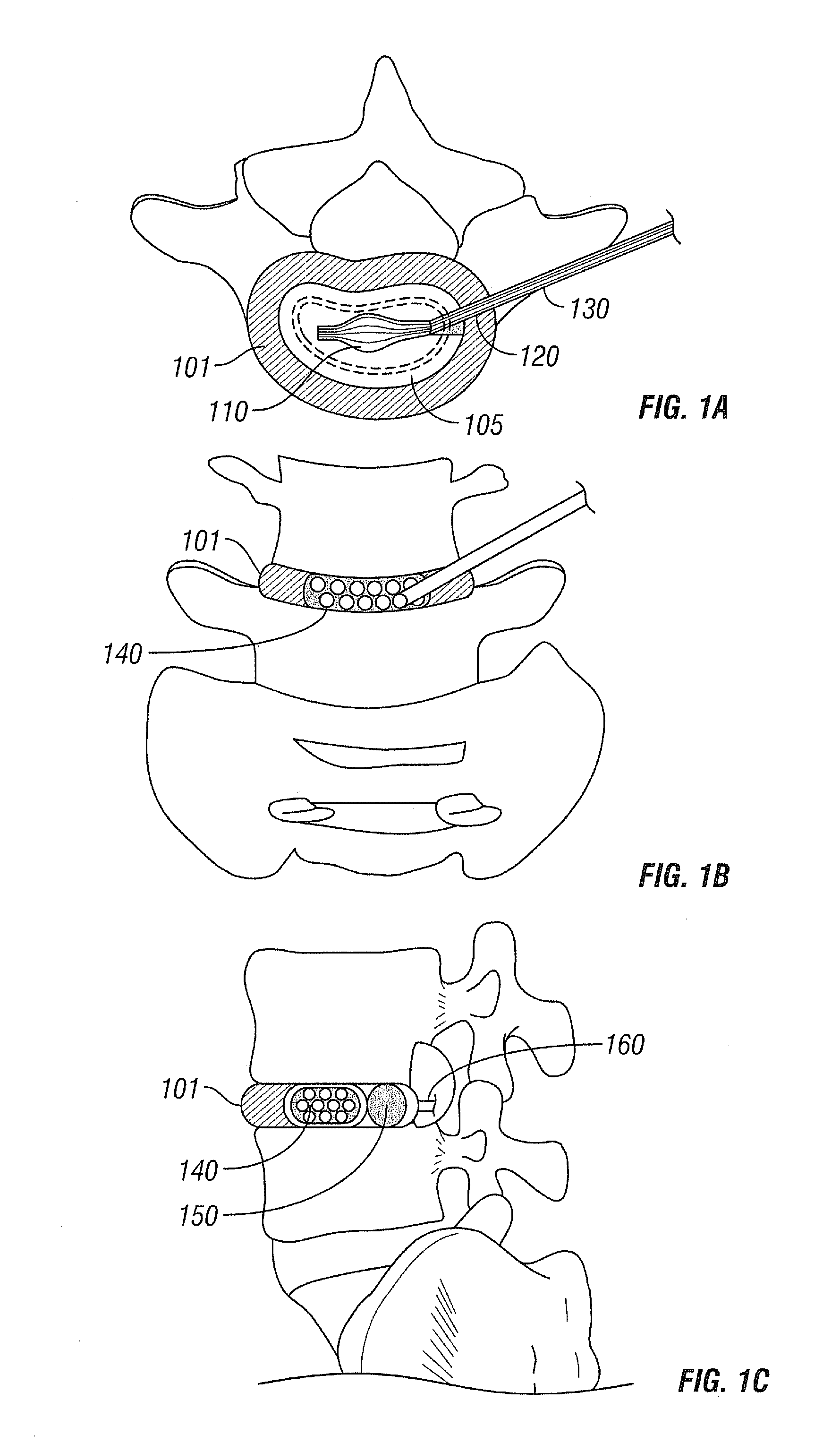 Intervertebral Nucleus and Annulus Implants and Method of Use Thereof