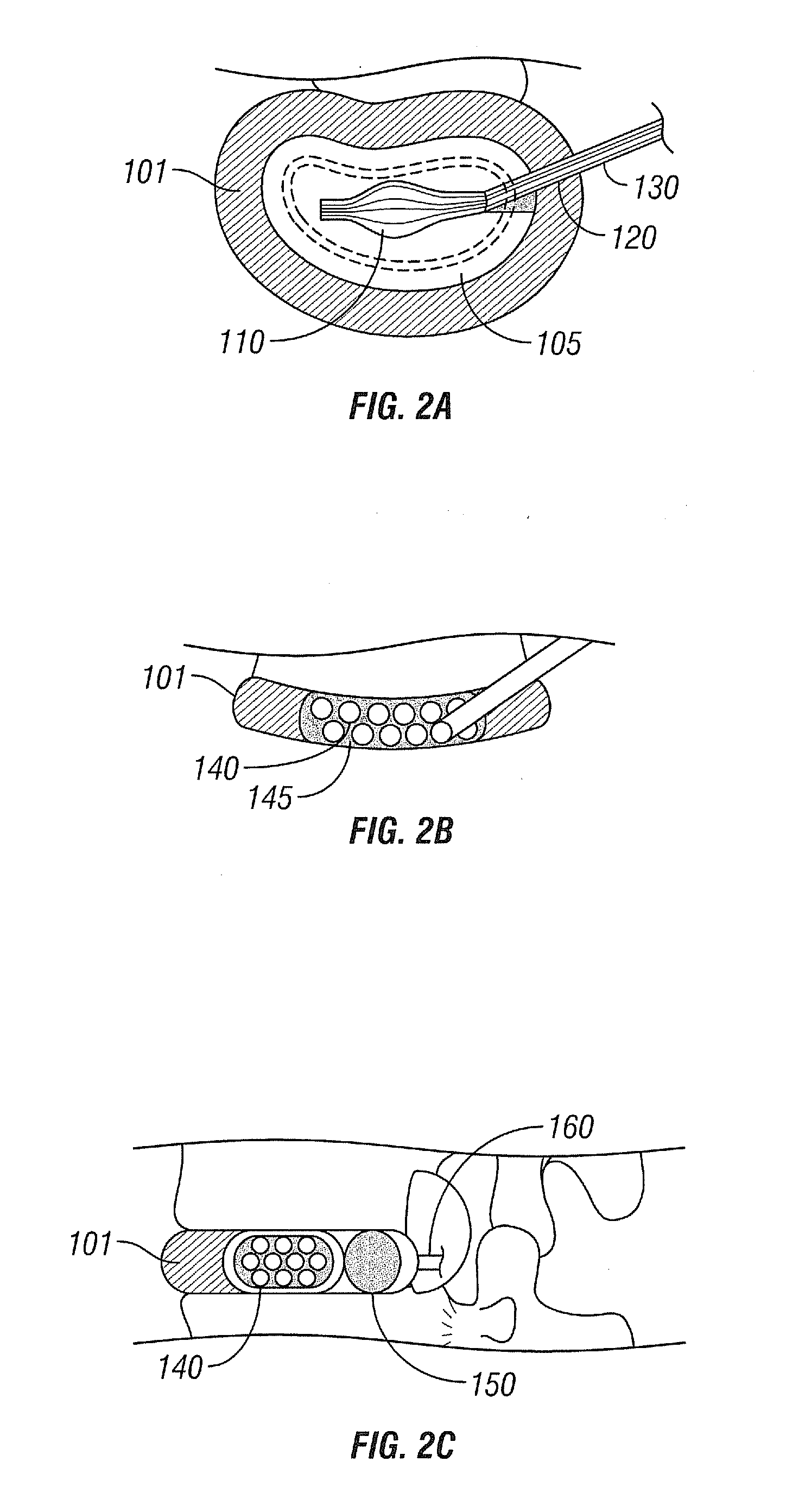 Intervertebral Nucleus and Annulus Implants and Method of Use Thereof
