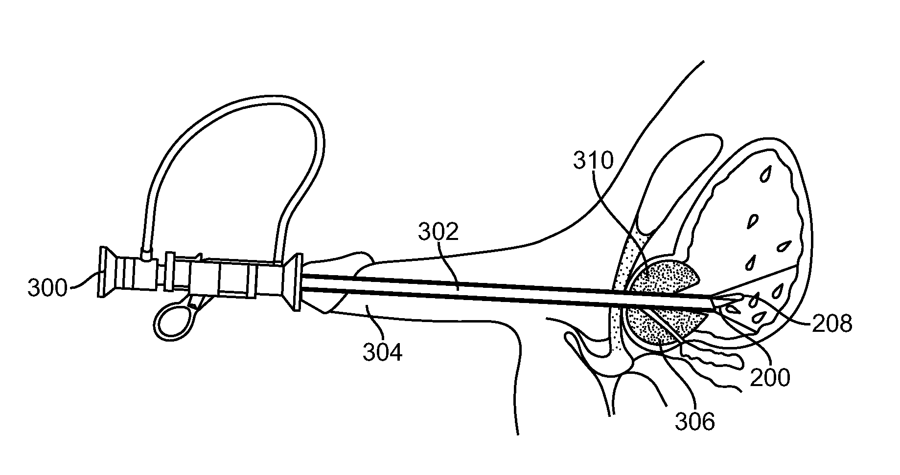 Multi-wavelength laser and method for contact ablation of tissue