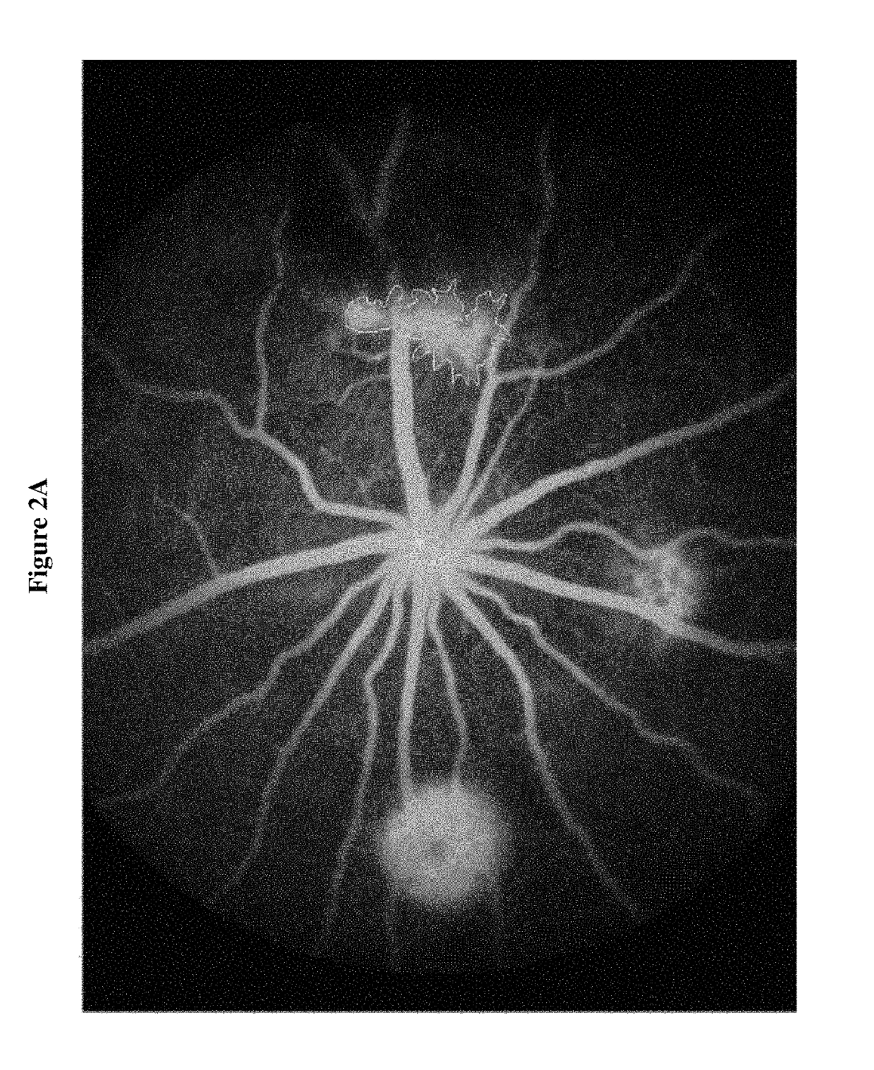 Compositions and methods for treatment of diabetic macular edema