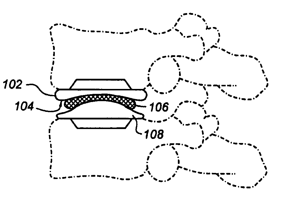 Artificial disc replacements with articulating components