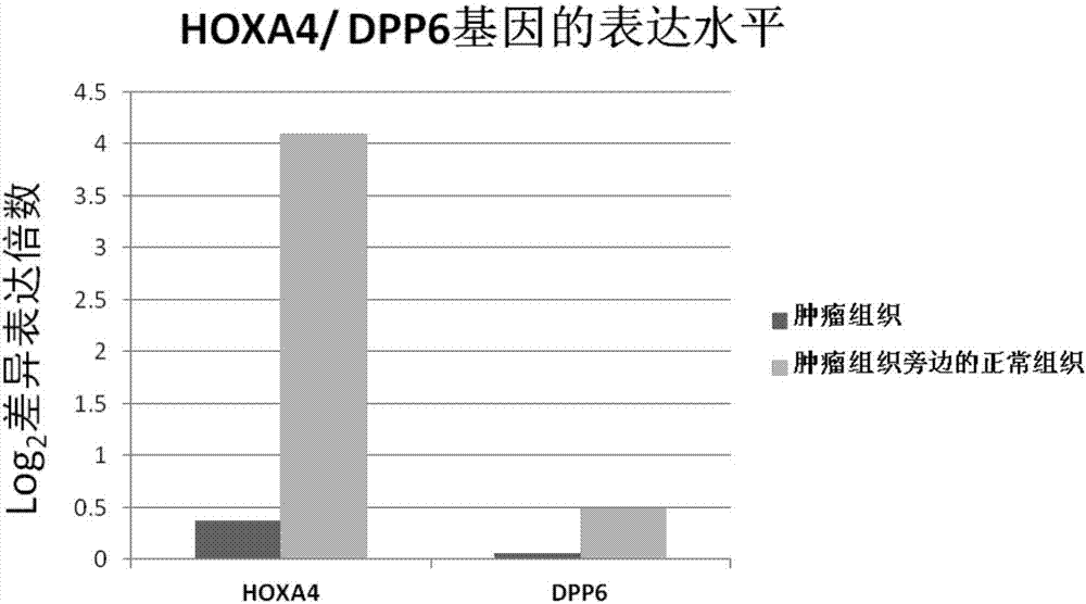 Kit for diagnosis and assessment of breast cancer, and detection and applications of methylated HOXA4/DPP6 gene