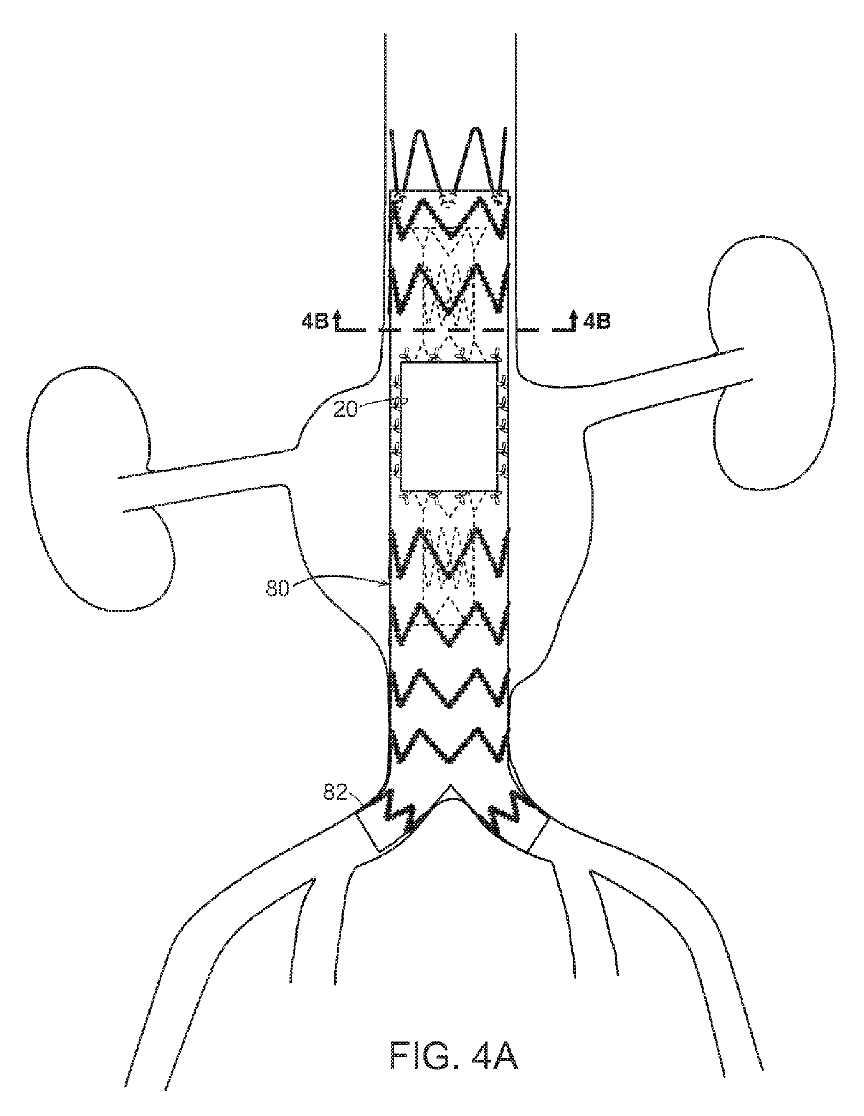 Stent Grafts And Methods Of Use For Treating Aneurysms