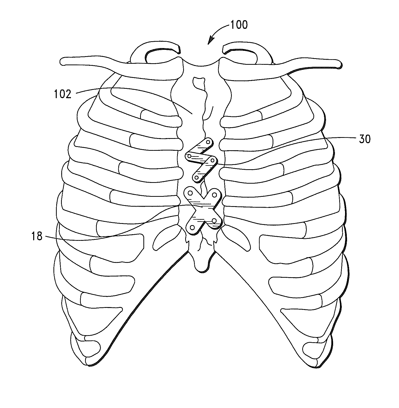 Sternal Closure Apparatus, System and Method