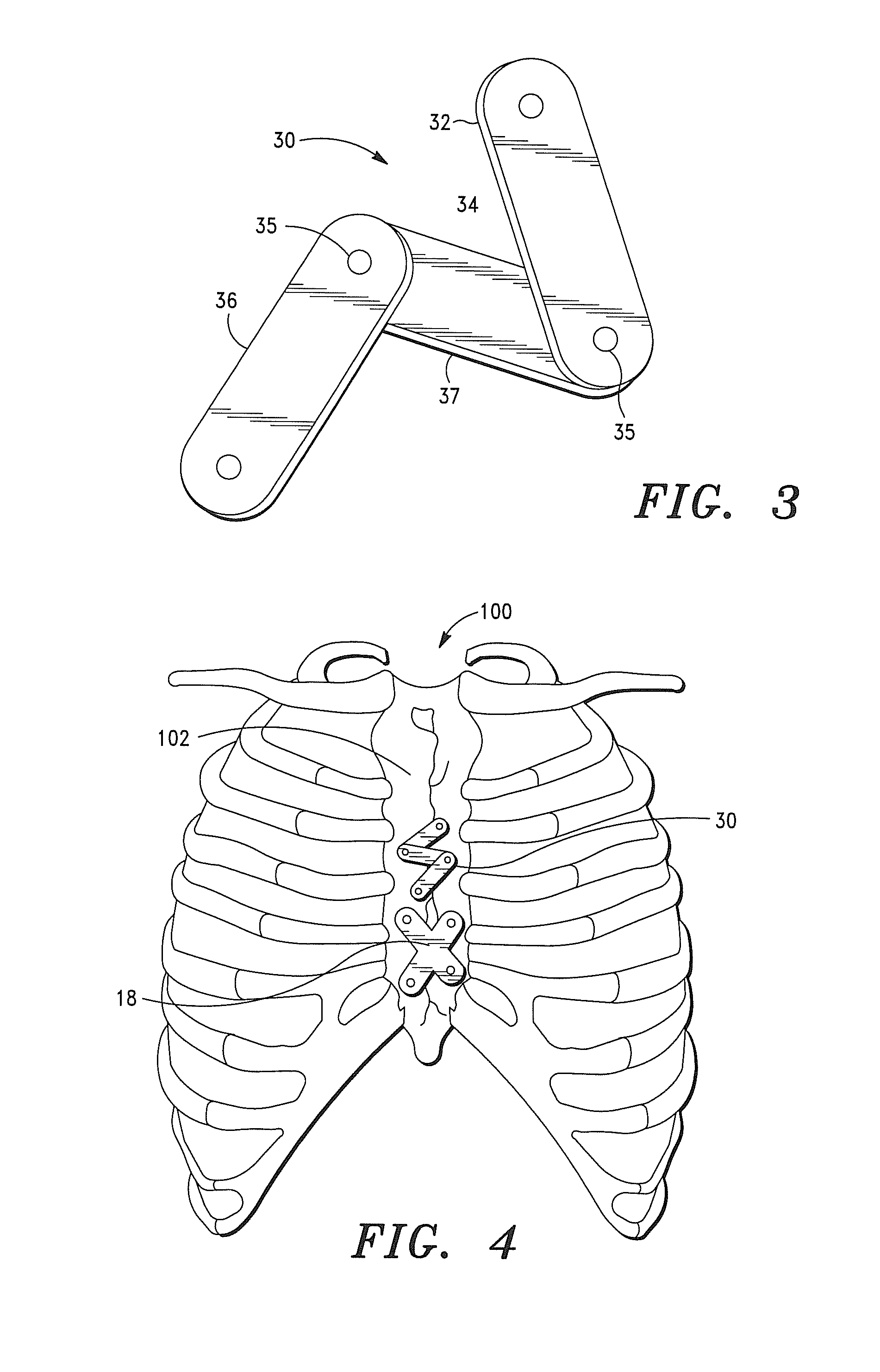 Sternal Closure Apparatus, System and Method