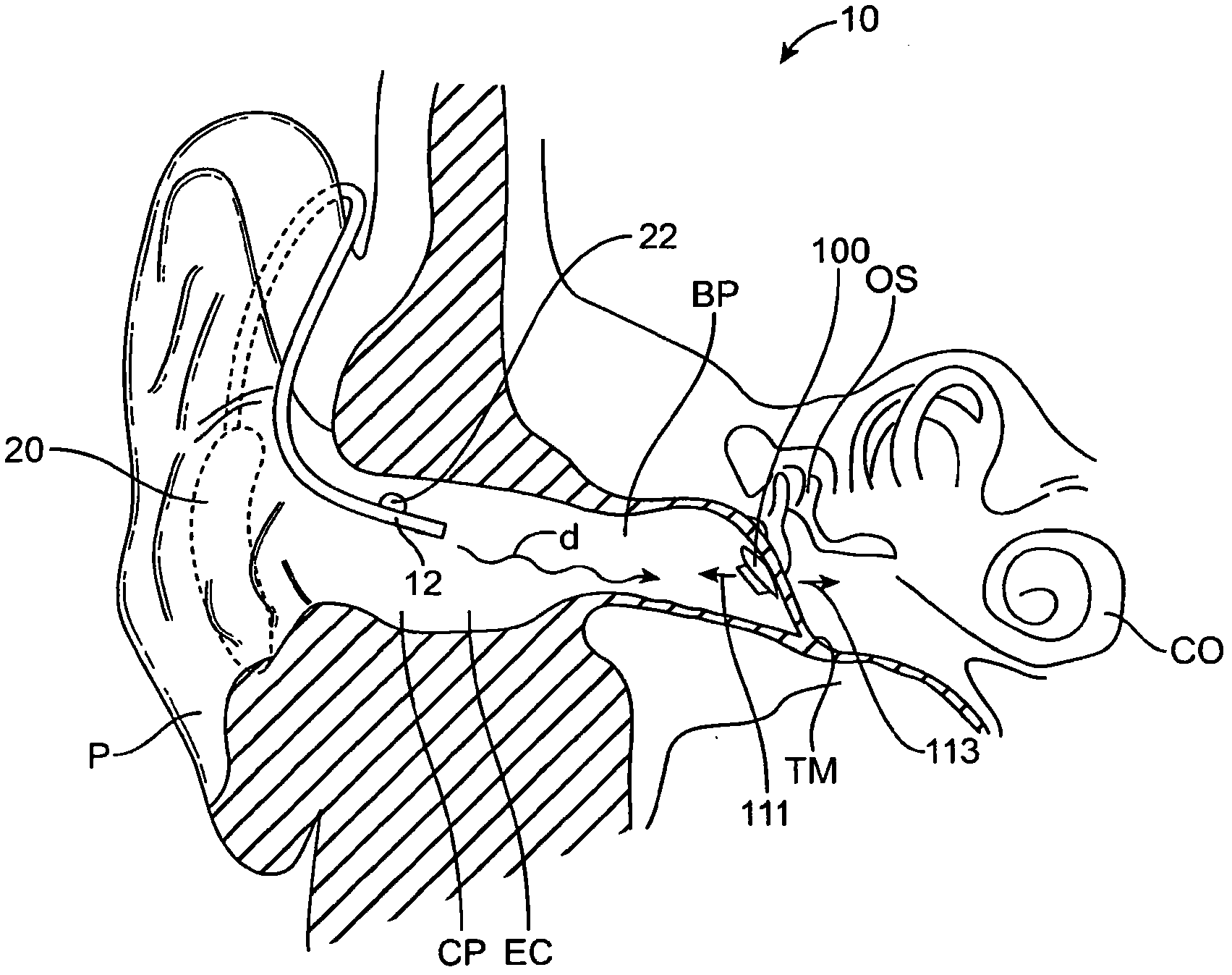 Balanced armature device and method for hearing
