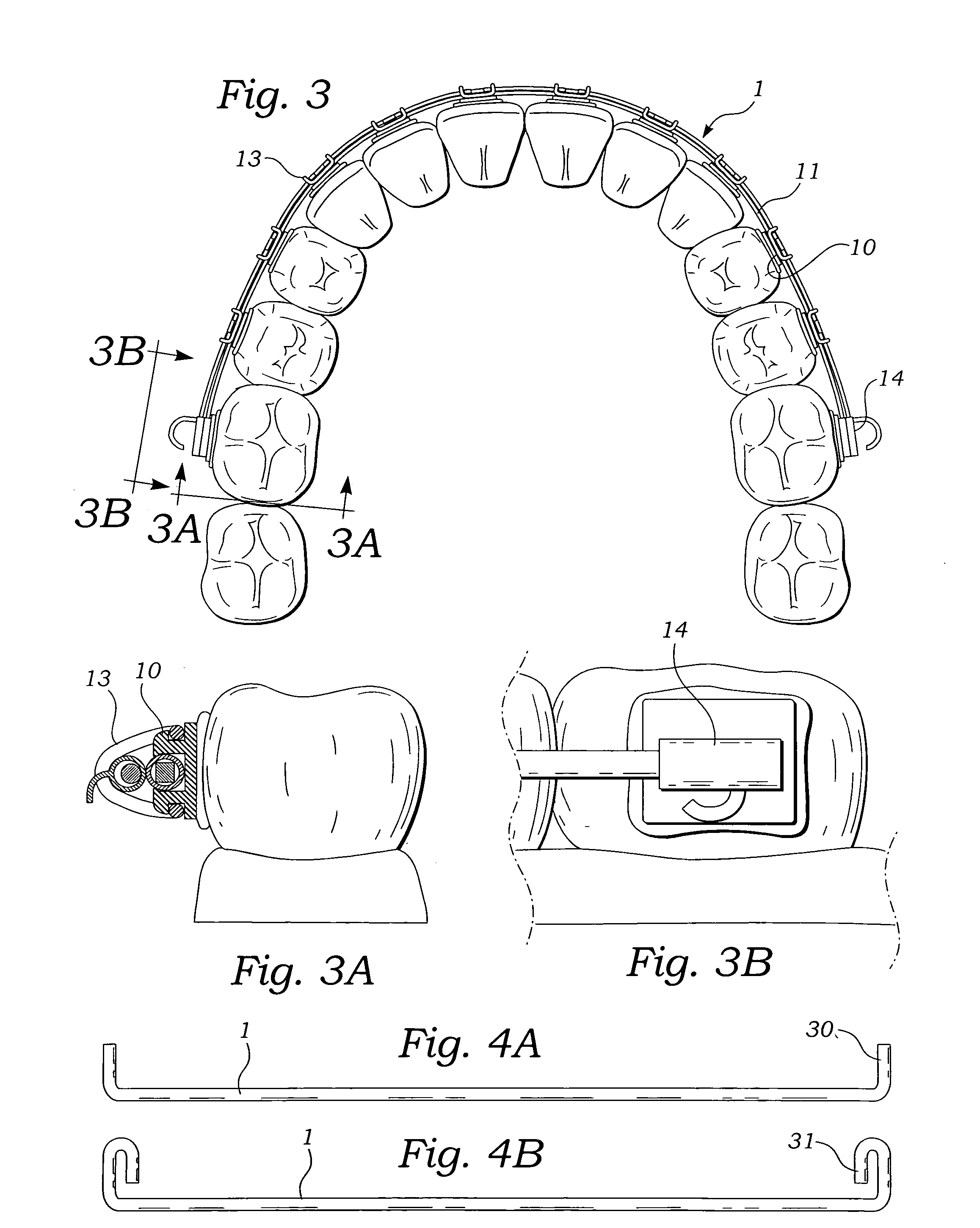 Orthodontic accessory arch bar