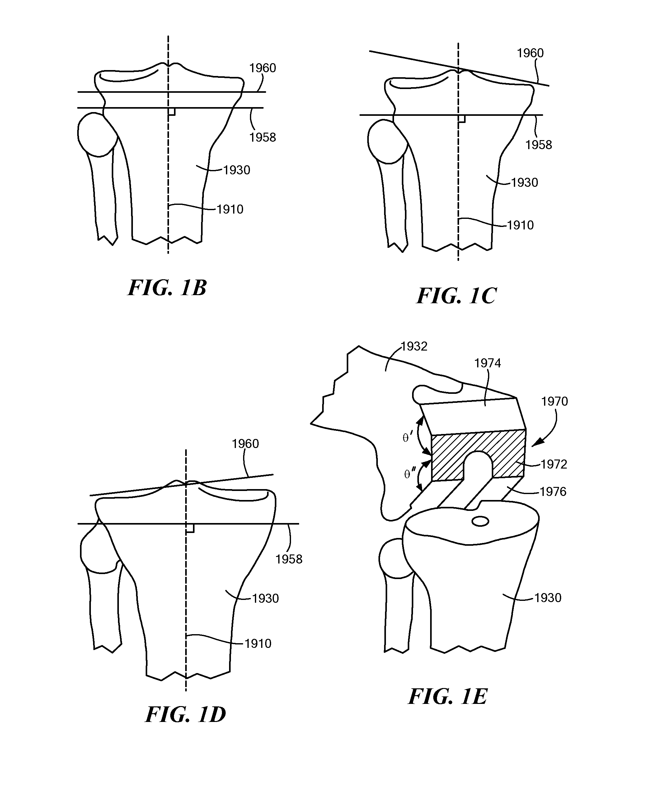 Patient Selectable Joint Arthroplasty Devices and Surgical Tools