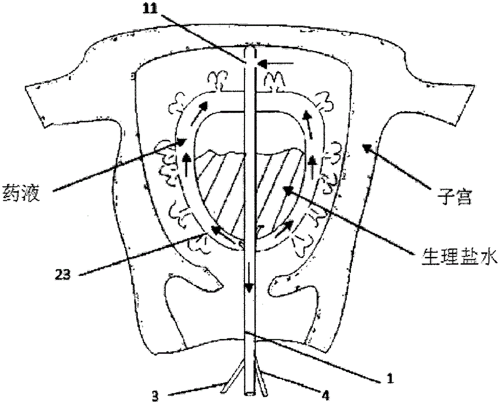 Medicine application device for controlling intrauterine adhesion