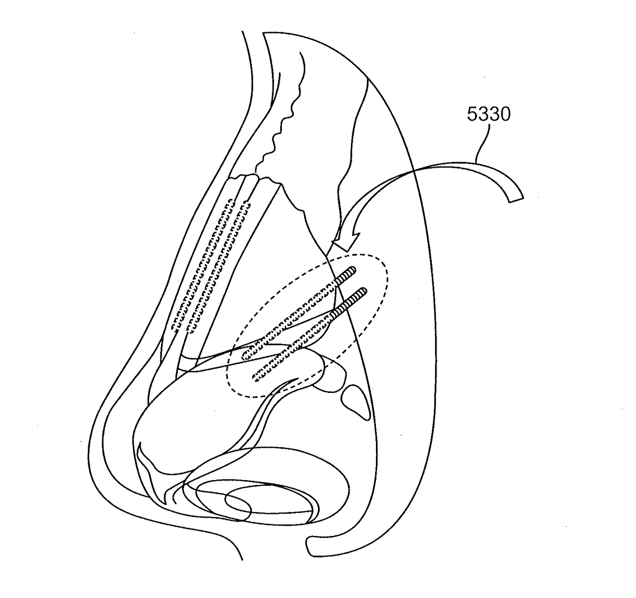 Nasal implants and systems and methods of use