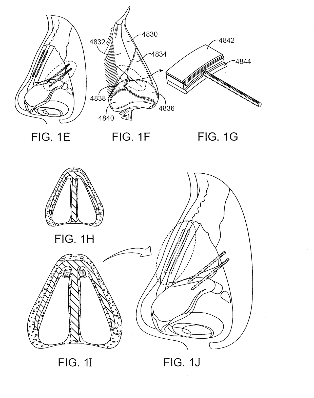 Nasal implants and systems and methods of use