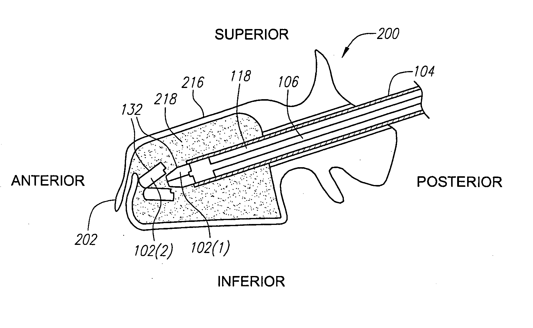 Apparatus and methods of reducing bone compression fractures using wedges