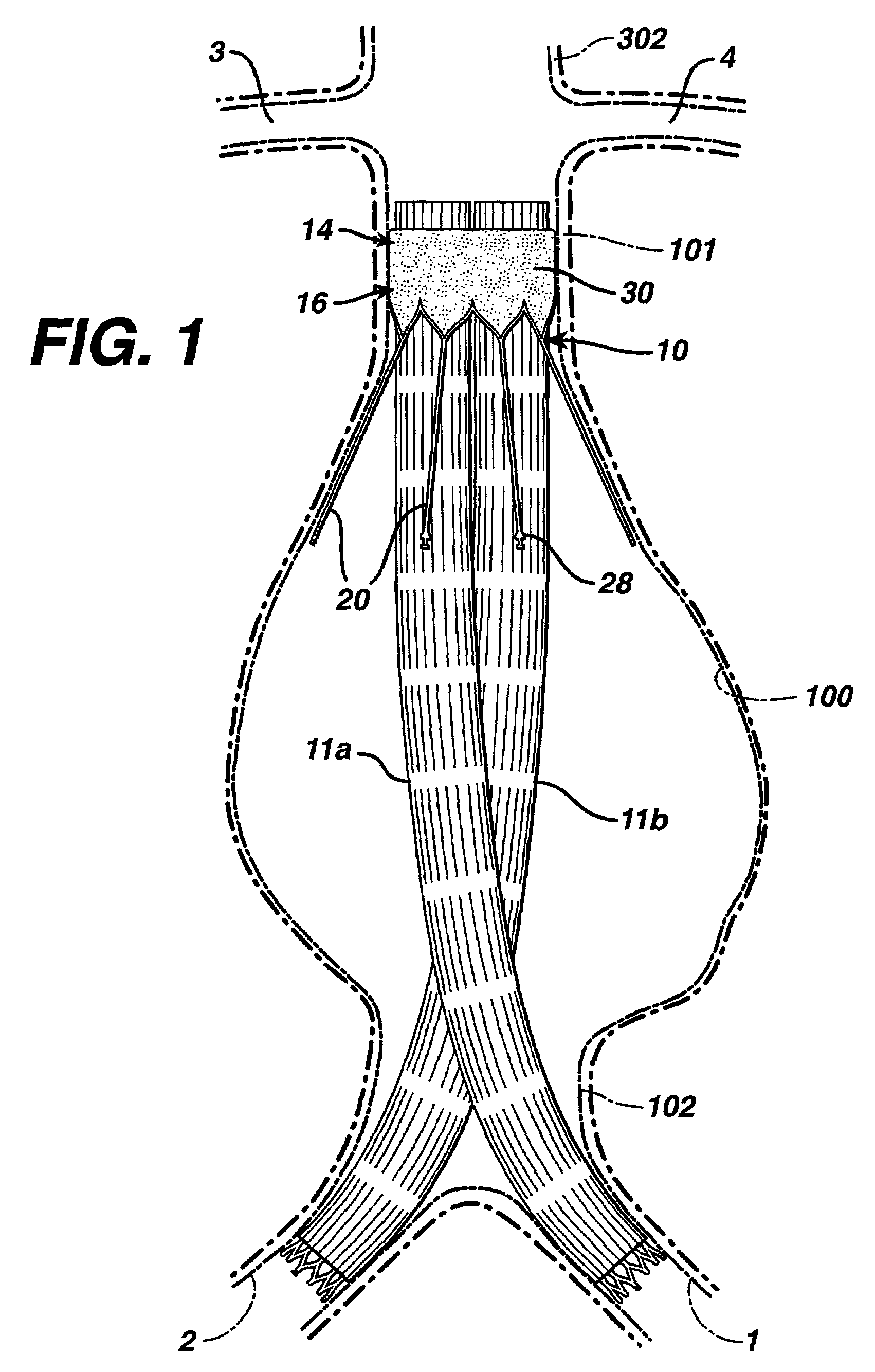 Bilateral extension prosthesis and method of delivery