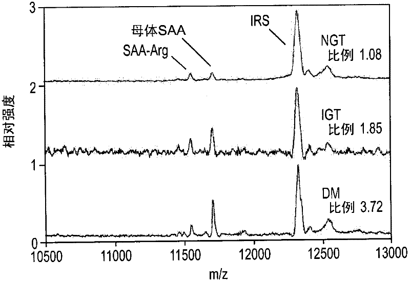 Phenotypic ratio of serum amyloid in pre- and type 2 diabetes