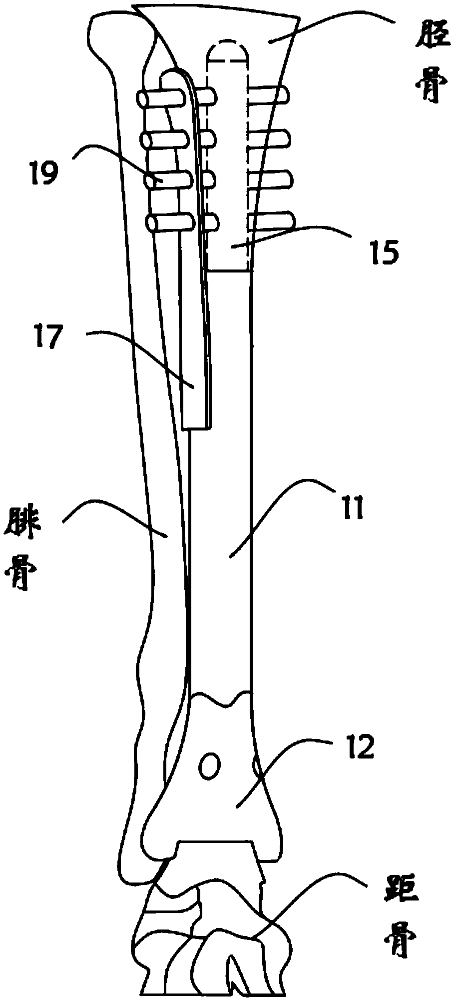 Middle and distal tibia tumor type prosthesis and preparation device and method thereof