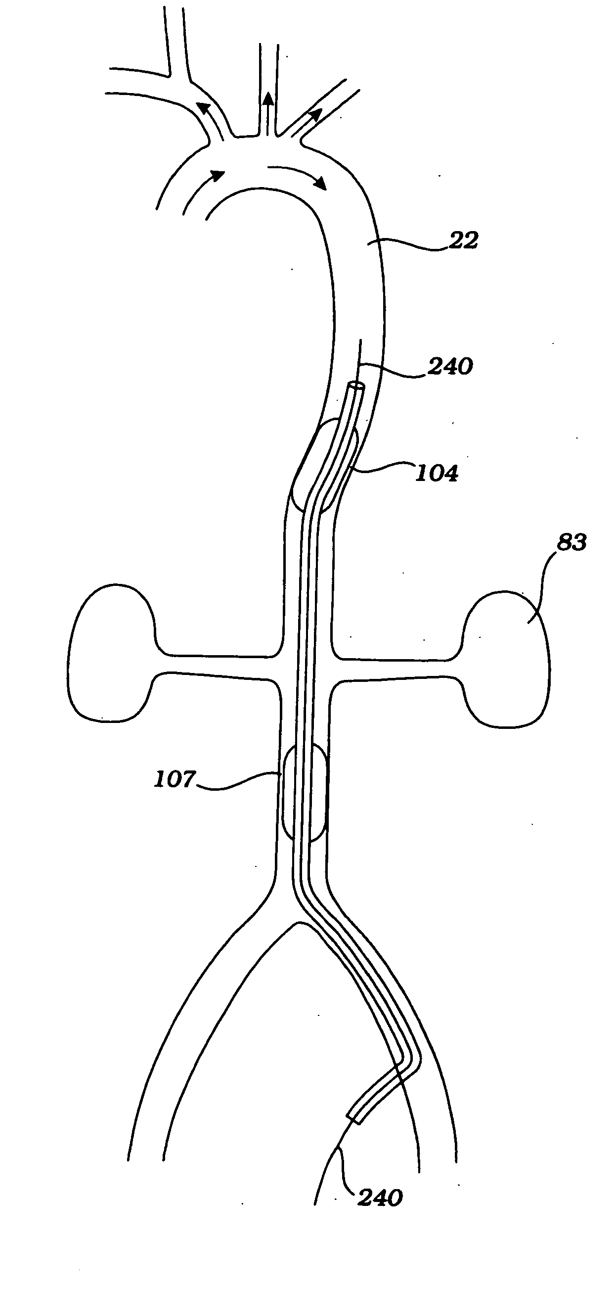 Partial aortic occlusion devices and methods for cerebral perfusion augmentation
